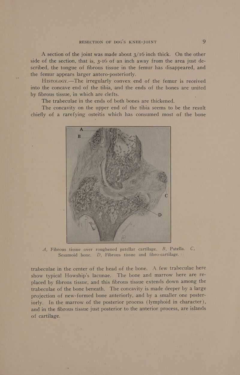 A section of the joint was made about 3/16 inch thick. On the other side of the section, that is, 3-16 of an inch away from the area just de- scribed, the tongue of fibrous tissue in the femur has disappeared, and the femur appears larger antero-posteriorly. Histotocy.—The irregularly convex end of the femur is received into the concave end of the tibia, and the ends of the bones are united by fibrous tissue, in which are clefts. The trabeculae in the ends of both bones are thickened. The concavity on the upper end of the tibia seems to be the result chiefly of a rarefying osteitis which has consumed most of the bone s A, Fibrous tissue over roughened patellar cartilage. B, Patella. C, Sesamoid bone. D, Fibrous tissue and fibro-cartilage. trabeculae in the center of the head of the bone. A few trabeculae here show typical Howship’s lacunae. The bone and marrow here are re- placed by fibrous tissue, and this fibrous tissue extends down among the trabeculae of the bone beneath. The concavity is made deeper by a large projection of new-formed bone anteriorly, and by a smaller one poster- iorly. In the marrow of the posterior process (lymphoid in character), and in the fibrous tissue just posterior to the anterior process, are islands of cartilage. .