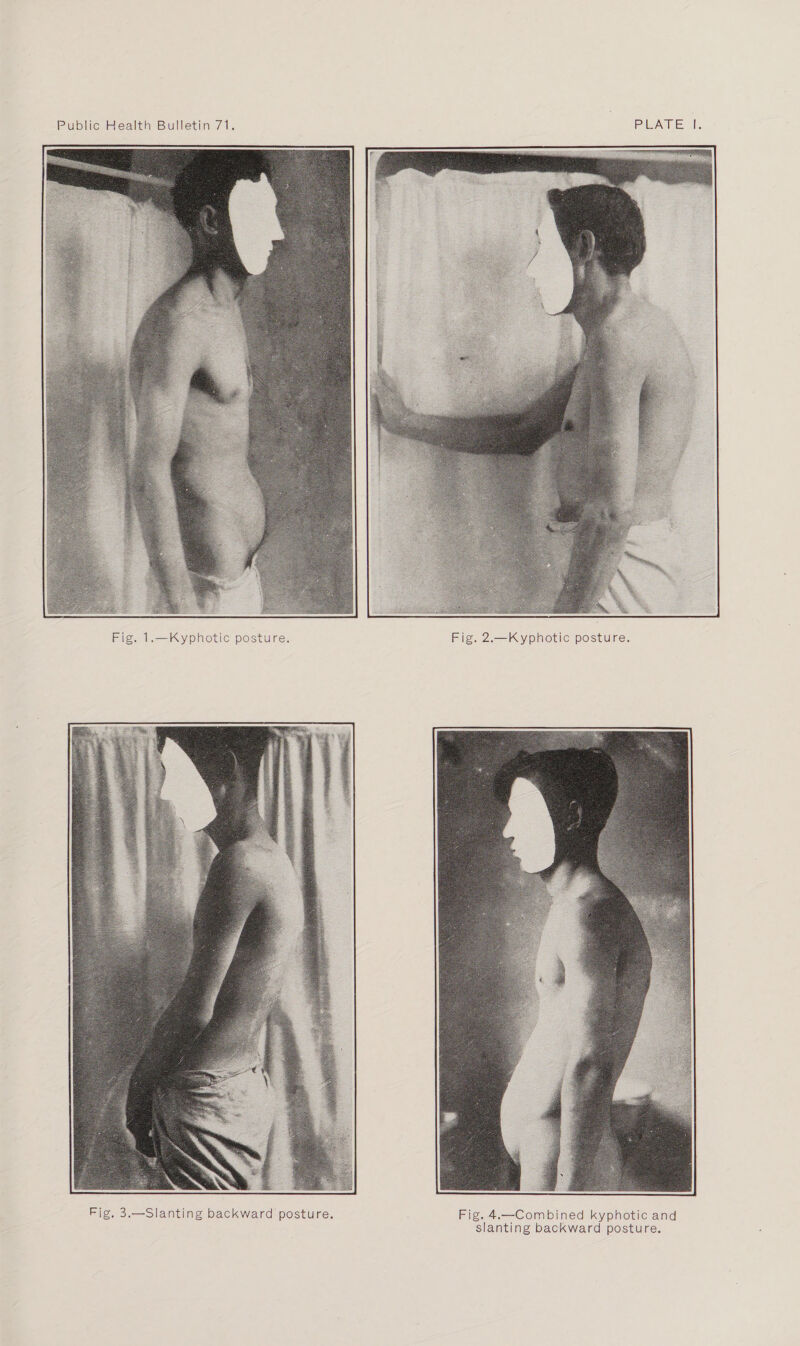 Fig. 1.—Kyphotic posture. Fig. 2.—Kyphotic posture. Fig. 3.—Slanting backward posture. Fig. 4.—Combined kyphotic and slanting backward posture.