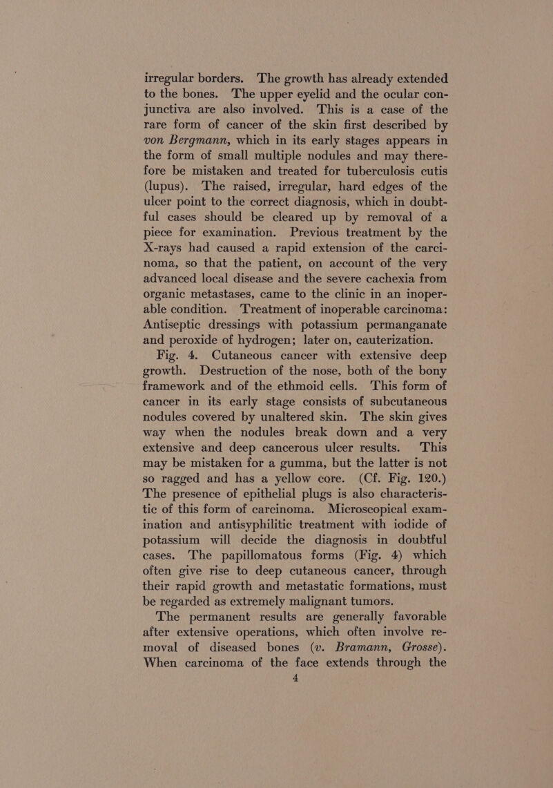 irregular borders. ‘The growth has already extended to the bones. ‘The upper eyelid and the ocular con- junctiva are also involved. This is a case of the rare form of cancer of the skin first described by von Bergmann, which in its early stages appears in the form of small multiple nodules and may there- fore be mistaken and treated for tuberculosis cutis (lupus). ‘The raised, irregular, hard edges of the ulcer point to the correct diagnosis, which in doubt- ful cases should be cleared up by removal of a piece for examination. Previous treatment by the X-rays had caused a rapid extension of the carci- noma, so that the patient, on account of the very advanced local disease and the severe cachexia from organic metastases, came to the clinic in an inoper- able condition. Treatment of inoperable carcinoma: Antiseptic dressings with potassium permanganate and peroxide of hydrogen; later on, cauterization. Fig. 4. Cutaneous cancer with extensive deep growth. Destruction of the nose, both of the bony framework and of the ethmoid cells. ‘This form of cancer in its early stage consists of subcutaneous nodules covered by unaltered skin. The skin gives way when the nodules break down and a very extensive and deep cancerous ulcer results. This may be mistaken for a gumma, but the latter is not so ragged and has a yellow core. (Cf. Fig. 120.) The presence of epithelial plugs is also characteris- tic of this form of carcinoma. Microscopical exam- ination and antisyphilitic treatment with iodide of potassium will decide the diagnosis in doubtful eases. The papillomatous forms (Fig. 4) which often give rise to deep cutaneous cancer, through their rapid growth and metastatic formations, must be regarded as extremely malignant tumors. The permanent results are generally favorable after extensive operations, which often involve re- moval of diseased bones (vw. Bramann, Grosse). When carcinoma of the face extends through the