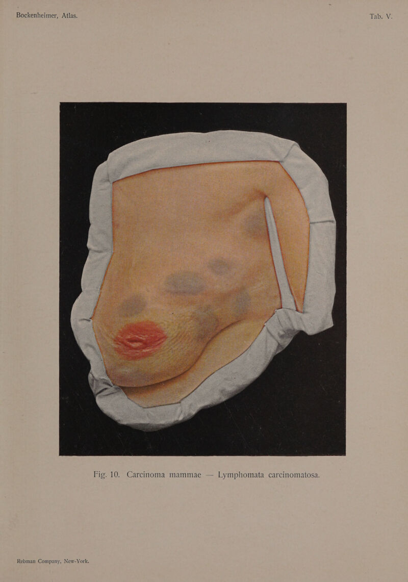 Ka NEE Fig. 10. Carcinoma mammae — Lymphomata carcinomatosa.