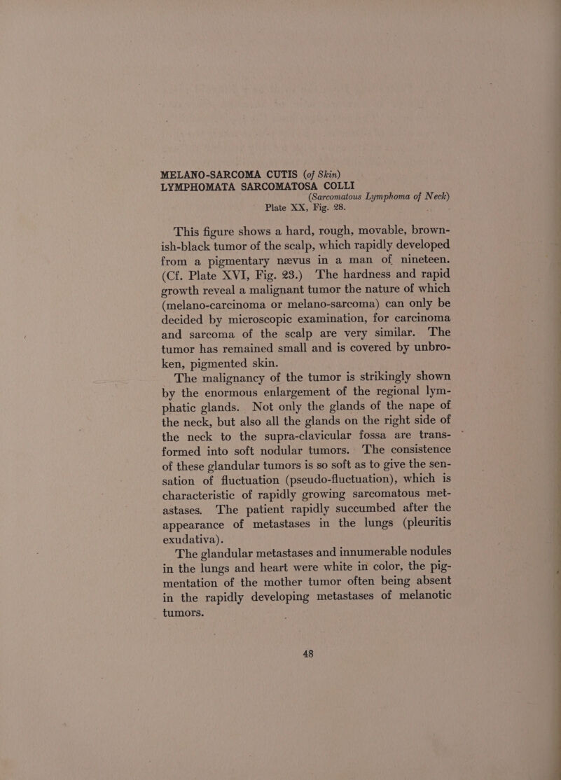 LYMPHOMATA SARCOMATOSA COLLI (Sarcomatous Lymphoma of Neck) Plate XX, Fig. 28. This figure shows a hard, rough, movable, brown- ish-black tumor of the scalp, which rapidly developed from a pigmentary nevus in a man of nineteen. (Cf. Plate XVI, Fig. 23.) The hardness and rapid growth reveal a malignant tumor the nature of which (melano-carcinoma or melano-sarcoma) can only be decided by microscopic examination, for carcinoma and sarcoma of the scalp are very similar. The tumor has remained small and is covered by unbro- ken, pigmented skin. The malignancy of the tumor is strikingly shown by the enormous enlargement of the regional lym- phatic glands. Not only the glands of the nape of the neck, but also all the glands on the right side of the neck to the supra-clavicular fossa are trans- formed into soft nodular tumors. The consistence of these glandular tumors is so soft as to give the sen- sation of fluctuation (pseudo-fluctuation), which is characteristic of rapidly growing sarcomatous met- astases. ‘The patient rapidly succumbed after the appearance of metastases in the lungs (pleuritis exudativa). The glandular metastases and innumerable nodules in the lungs and heart were white in color, the pig- mentation of the mother tumor often being absent in the rapidly developing metastases of melanotic tumors. 48 EE
