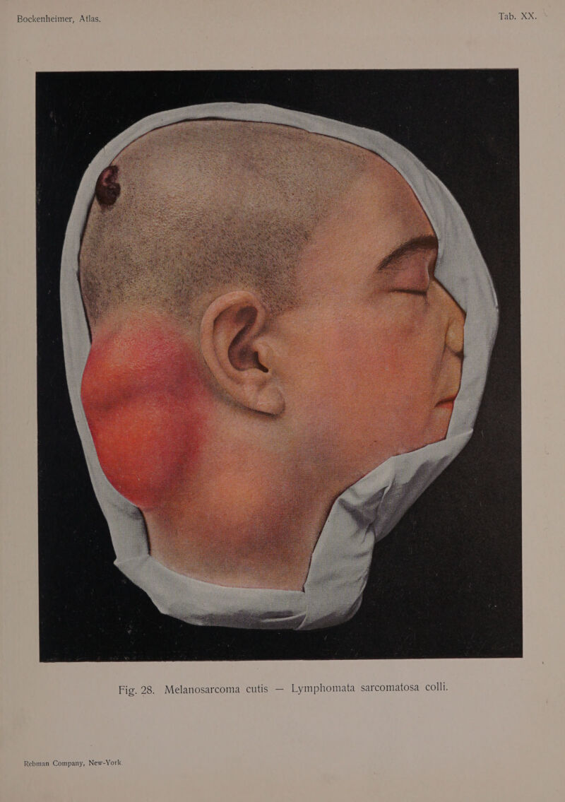 Tab. XX. Bockenheimer, Atlas. comatosa colli. Sar ata Melanosarcoma cutis — Lymphom Fig. 28.