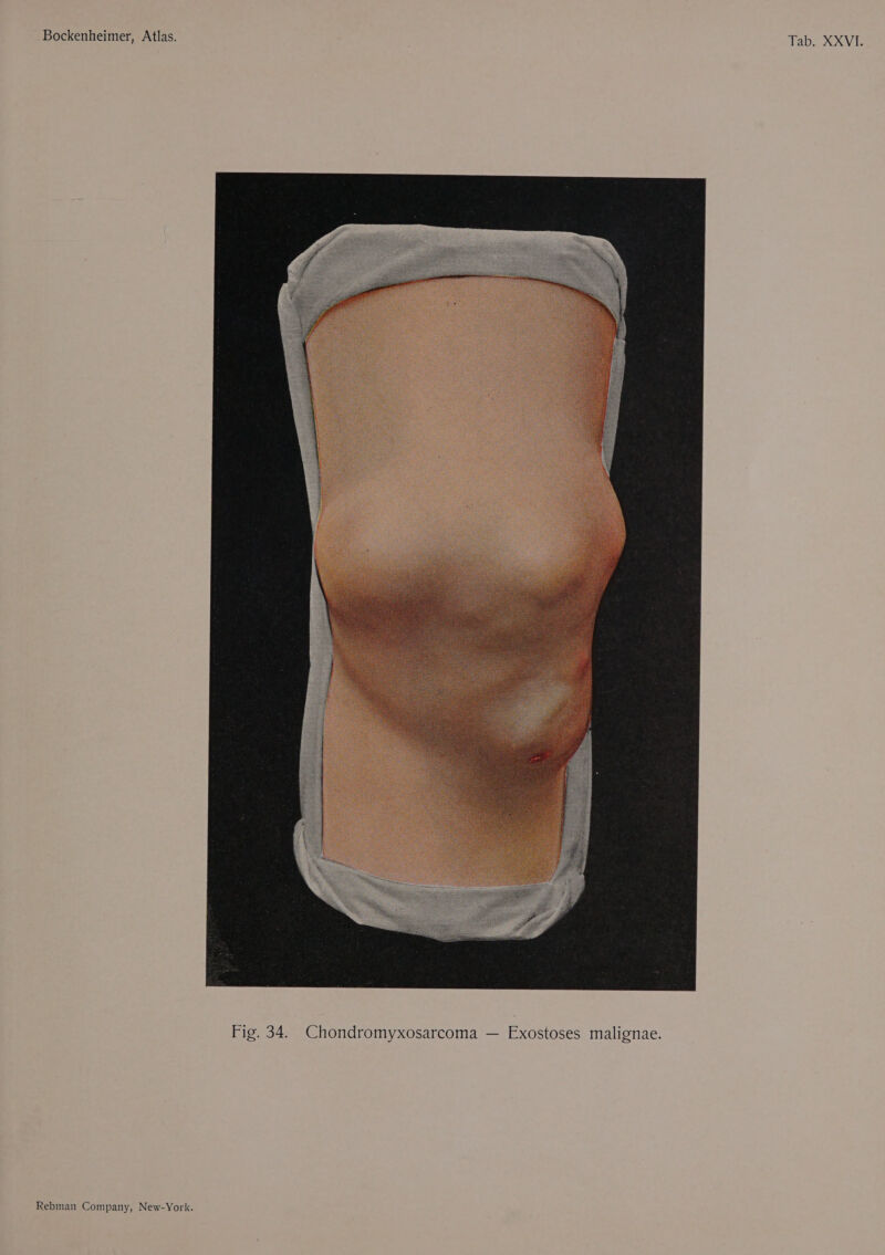 WH Wy. Fig. 34. Chondromyxosarcoma — Exostoses malignae.