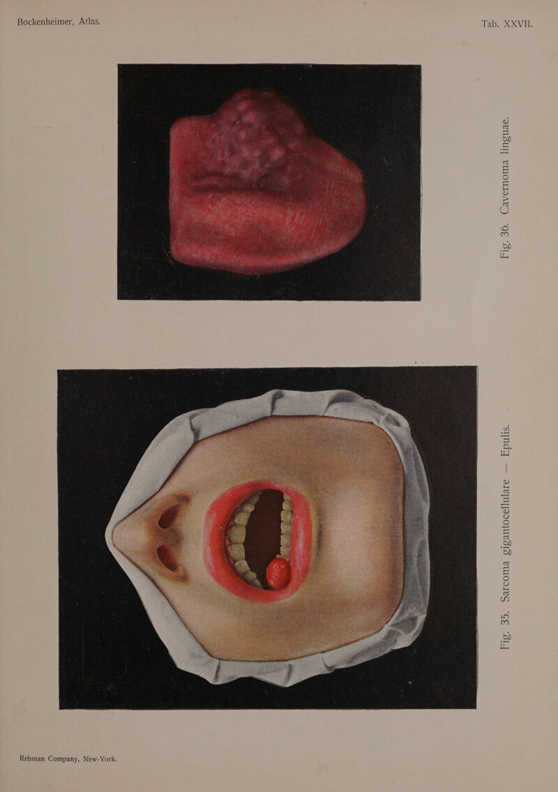 . 36. Cavernoma linguae. 1g S i antocellulare — Epul o [&gt; i 35, sarcoma ¢