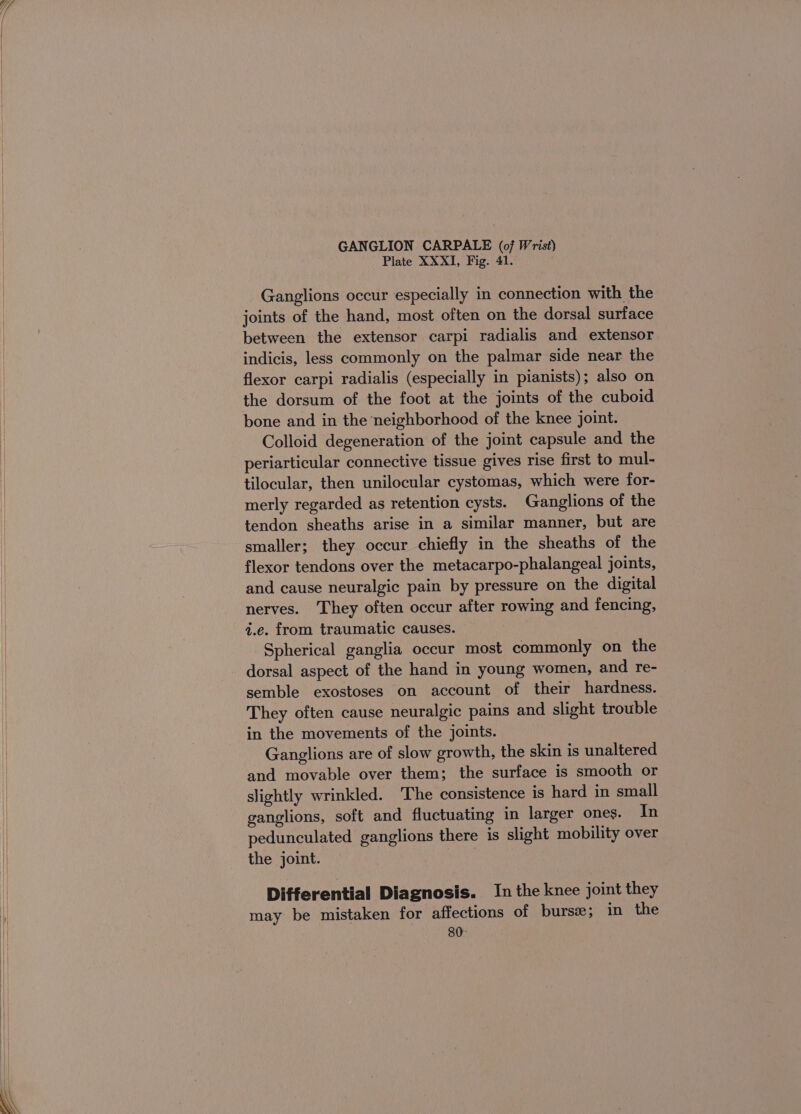 GANGLION CARPALE (of Wrist) Plate XXXI, Fig. 41. Ganglions occur especially in connection with the joints of the hand, most often on the dorsal surface between the extensor carpi radialis and extensor indicis, less commonly on the palmar side near the flexor carpi radialis (especially in pianists); also on the dorsum of the foot at the joints of the cuboid bone and in the neighborhood of the knee joint. Colloid degeneration of the joint capsule and the periarticular connective tissue gives rise first to mul- tilocular, then unilocular cystomas, which were for- merly regarded as retention cysts. Ganglions of the tendon sheaths arise in a similar manner, but are smaller; they occur chiefly in the sheaths of the flexor tendons over the metacarpo-phalangeal joints, and cause neuralgic pain by pressure on the digital nerves. They often occur after rowing and fencing, i.e. from traumatic causes. Spherical ganglia occur most commonly on the dorsal aspect of the hand in young women, and re- semble exostoses on account of their hardness. They often cause neuralgic pains and slight trouble in the movements of the joints. Ganglions are of slow growth, the skin is unaltered and movable over them; the surface is smooth or slightly wrinkled. The consistence is hard in small ganglions, soft and fluctuating in larger ones. In pedunculated ganglions there is slight mobility over the joint. Differential Diagnosis. In the knee joint they may be mistaken for affections of burs; in the 80: