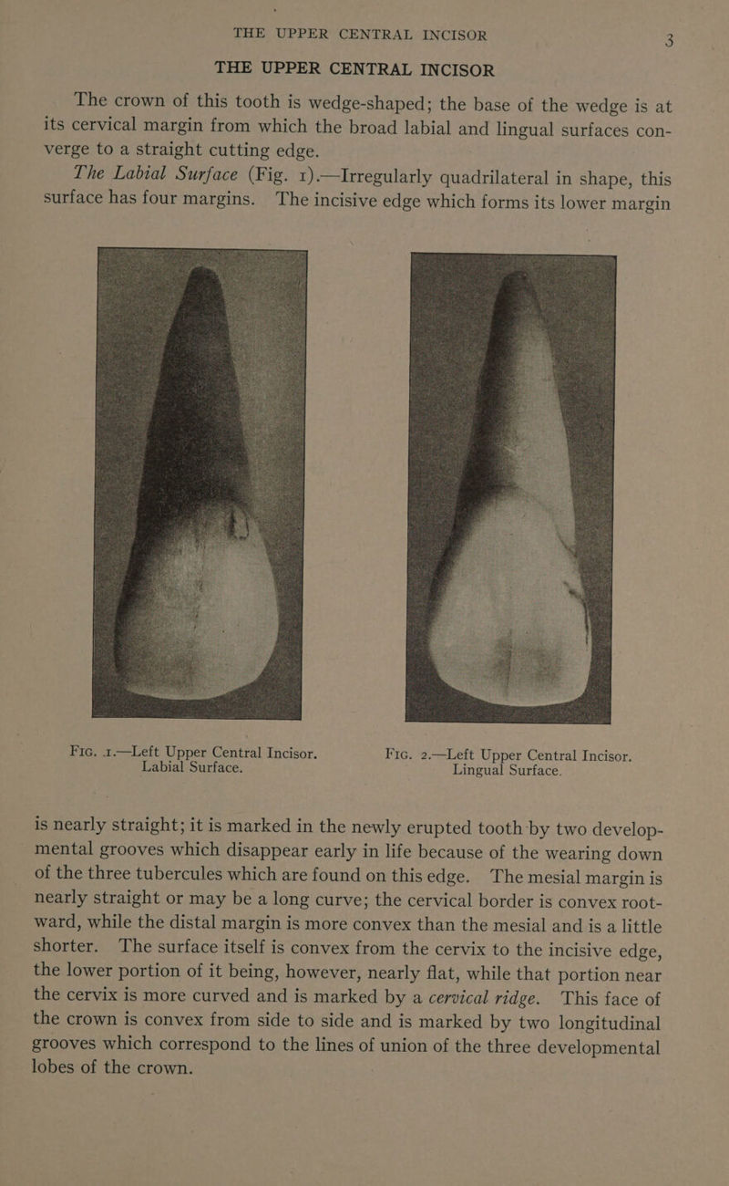 . THE UPPER CENTRAL INCISOR 3 THE UPPER CENTRAL INCISOR The crown of this tooth is wedge-shaped; the base of the wedge is at its cervical margin from which the broad labial and lingual surfaces con- verge to a straight cutting edge. Lhe Labial Surface (Fig. 1).—Irregularly aGudaieewns in shape, this surface has four margins. The incisive edge which forms its lower margin Fic. 1.—Left Upper Central Incisor. Fic. 2.—Left Upper Central Incisor. Labial Surface. Lingual Surface. is nearly straight; it is marked in the newly erupted tooth by two develop- mental grooves which disappear early in life because of the wearing down of the three tubercules which are found on this edge. The mesial margin is nearly straight or may be a long curve; the cervical border is convex root- ward, while the distal margin is more convex than the mesial and is a little shorter. The surface itself is convex from the cervix to the incisive edge, the lower portion of it being, however, nearly flat, while that portion near the cervix is more curved and is marked by a cervical ridge. ‘This face of the crown is convex from side to side and is marked by two longitudinal grooves which correspond to the lines of union of the three developmental lobes of the crown.