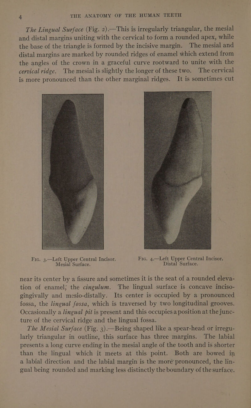 The Lingual Surface (Fig. 2)—This is irregularly triangular, the mesial and distal margins uniting with the cervical to form a rounded apex, while the base of the triangle is formed by the incisive margin. The mesial and distal margins are marked by rounded ridges of enamel which extend from the angles of the crown in a graceful curve rootward to unite with the cervical ridge. The mesial is slightly the longer of these two. The cervical is more pronounced than the other marginal ridges. It is sometimes cut Fic. 3.—Leit Upper Central Incisor. Fic. 4.—Left Upper Central Incisor. Mesial Surface. Distal Surface. near its center by a fissure and sometimes it is the seat of a rounded eleva- tion of enamel; the cingulum. ‘The lingual surface is concave inciso- gingivally and mesio-distally. Its center is occupied by a pronounced fossa, the lingual fossa, which is traversed by two longitudinal grooves. Occasionally a lingual pit is present and this occupies a position at the junc- ture of the cervical ridge and the lingual fossa. The Mesial Surface (Fig. 3) —Being shaped like a spear-head or irregu- larly triangular in outline, this surface has three margins. The labial presents a long curve ending in the mesial angle of the tooth and is shorter than the lingual which it meets at this point. Both are bowed in a labial direction and the labial margin is the moré pronounced, the lin- gual being rounded and marking less distinctly the boundary of the surface.