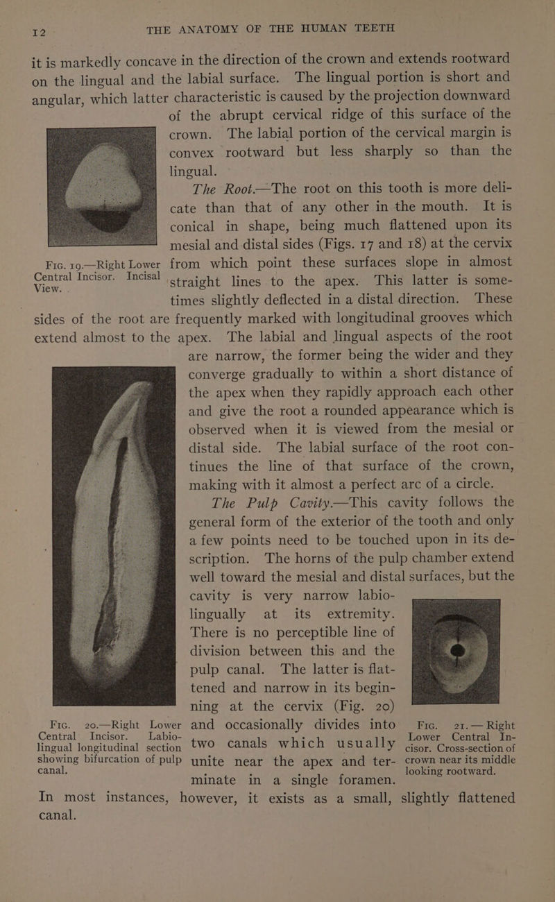 Fic. 19.—Right Lower Central Incisor. Incisal View. . of the abrupt cervical ridge of this surface of the crown. The labial portion of the cervical margin is convex rootward but less sharply so than the lingual. | | The Root——The root on this tooth is more deli- cate than that of any other in the mouth. It is conical in shape, being much flattened upon its mesial and distal sides (Figs. 17 and 18) at the cervix from which point these surfaces slope in almost straight lines to the apex. This latter is some- times slightly deflected in a distal direction. These are narrow, the former being the wider and they converge gradually to within a short distance of the apex when they rapidly approach each other and give the root a rounded appearance which is observed when it is viewed from the mesial or distal side. The labial surface of the root con- tinues the line of that surface of the crown, making with it almost a perfect arc of a circle. The Pulp Cavity—This cavity follows the general form of the exterior of the tooth and only afew points need to be touched upon in its de- scription. The horns of the pulp chamber extend well toward the mesial and distal surfaces, but the cavity is very narrow labio- lingually at its extremity. There is no perceptible line of division between this and the pulp canal. The latter is flat- tened and narrow in its begin- ning at the cervix (Fig. 20) Lower Central In- cisor. Cross-section of canal. canal. ; ‘ ‘ looking rootward. minate in a single foramen. however, it exists as a small, slightly flattened