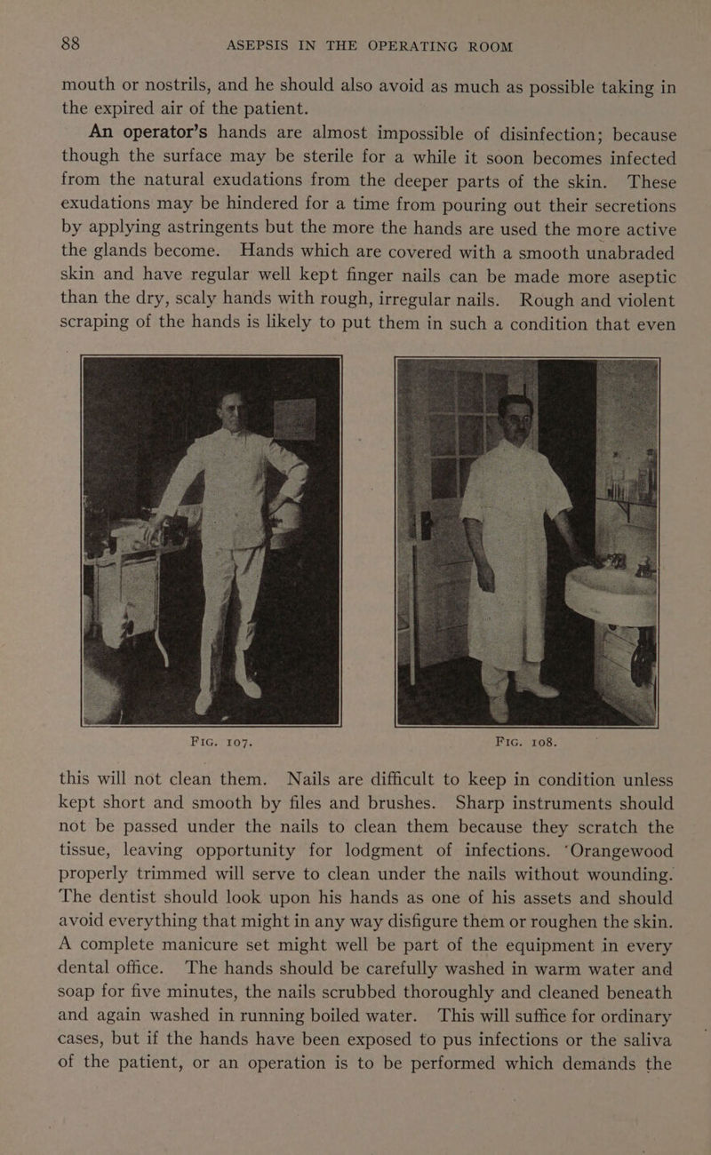 mouth or nostrils, and he should also avoid as much as possible taking in the expired air of the patient. An operator’s hands are almost impossible of disinfection; because though the surface may be sterile for a while it soon becomes infected from the natural exudations from the deeper parts of the skin. These exudations may be hindered for a time from pouring out their secretions by applying astringents but the more the hands are used the more active the glands become. Hands which are covered with a smooth unabraded skin and have regular well kept finger nails can be made more aseptic than the dry, scaly hands with rough, irregular nails. Rough and violent scraping of the hands is likely to put them in such a condition that even this will not clean them. Nails are difficult to keep in condition unless kept short and smooth by files and brushes. Sharp instruments should not be passed under the nails to clean them because they scratch the tissue, leaving opportunity for lodgment of infections. ‘Orangewood properly trimmed will serve to clean under the nails without wounding. The dentist should look upon his hands as one of his assets and should avoid everything that might in any way disfigure them or roughen the skin. A complete manicure set might well be part of the equipment in every dental office. The hands should be carefully washed in warm water and soap for five minutes, the nails scrubbed thoroughly and cleaned beneath and again washed in running boiled water. This will suffice for ordinary cases, but if the hands have been exposed to pus infections or the saliva of the patient, or an operation is to be performed which demands the