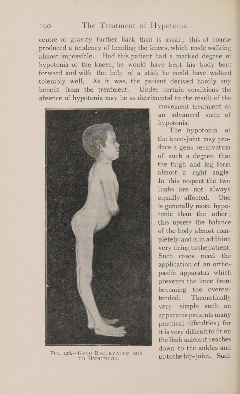 centre of gravity further back than is usual; this of course produced a tendency of bending the knees, which made walking almost impossible. Had this patient had a marked degree of hypotonia of the knees, he would have kept his body bent forward and with the help of a stick he could have walked tolerably well. As it was, the patient derived hardly any benefit from the treatment. Under certain conditions the absence of hypotonia may be as detrimental to the result of the movement treatment as an advanced state of hypotonia. The hypotonia of the knee-joint may pro- duce a genu recurvatum of such a degree that the thigh and leg form almost a right angle. In this respect the two limbs are not always equally affected. One is generally more hypo- tonic than the other; this upsets the balance of the body almost com- pletely and is in addition very tiring to the patient. Such. cases need. the application of an ortho- pedic apparatus which prevents the knee from becoming too overex- tended. Theoretically very simple such an apparatus presents many practical difficulties ; for itis very difficult to fit on the limb unless it reaches down to the ankles and