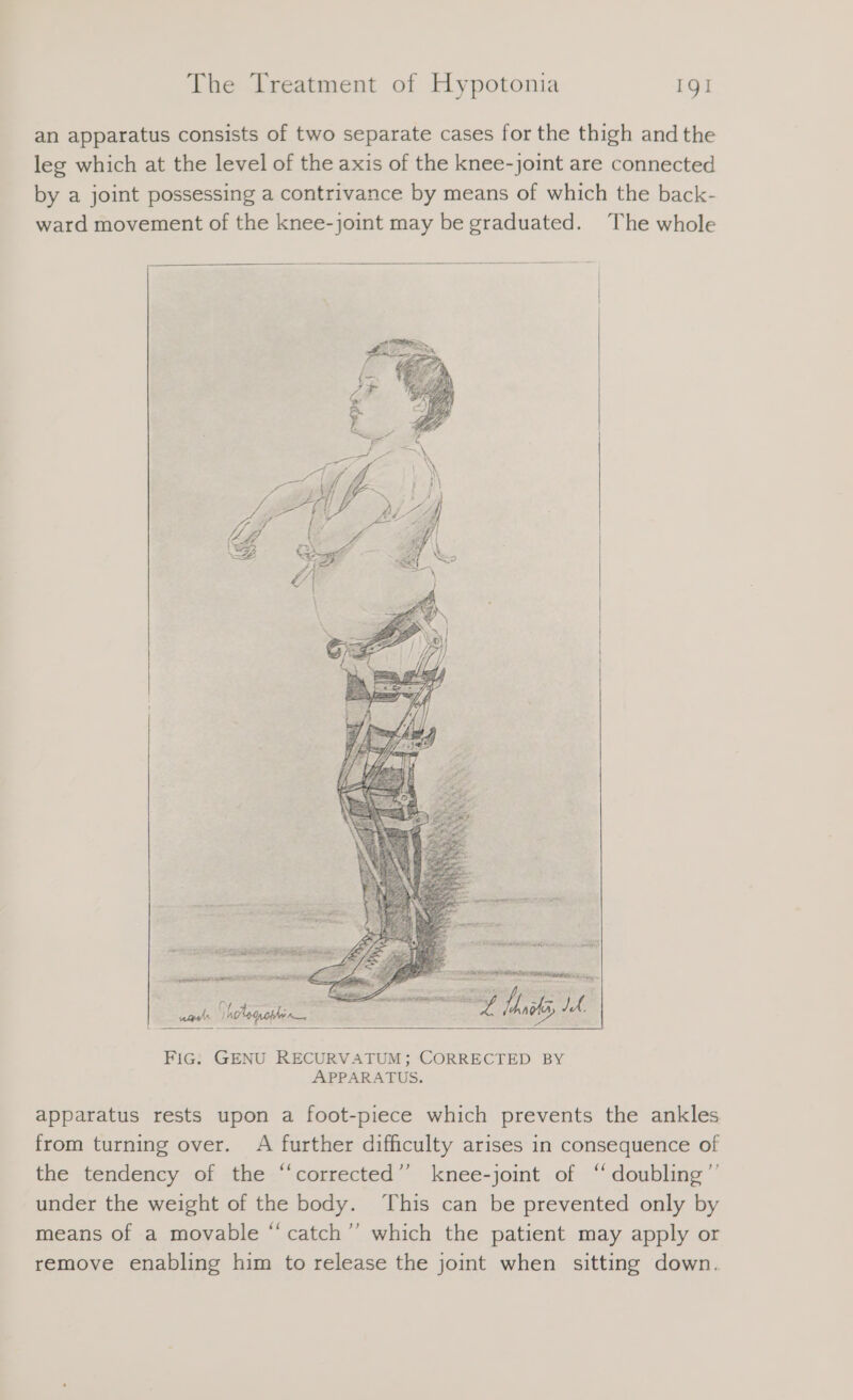 an apparatus consists of two separate cases for the thigh and the leg which at the level of the axis of the knee-joint are connected by a joint possessing a contrivance by means of which the back- ward movement of the knee-joint may be graduated. The whole FIG: GENU RECURVATUM; CORRECTED BY APPARATUS. apparatus rests upon a foot-piece which prevents the ankles from turning over. A further difficulty arises in consequence of the tendency of the “corrected” knee-joint of “ doubling’’ under the weight of the body. This can be prevented only by means of a movable “ catch” which the patient may apply or remove enabling him to release the joint when sitting down.