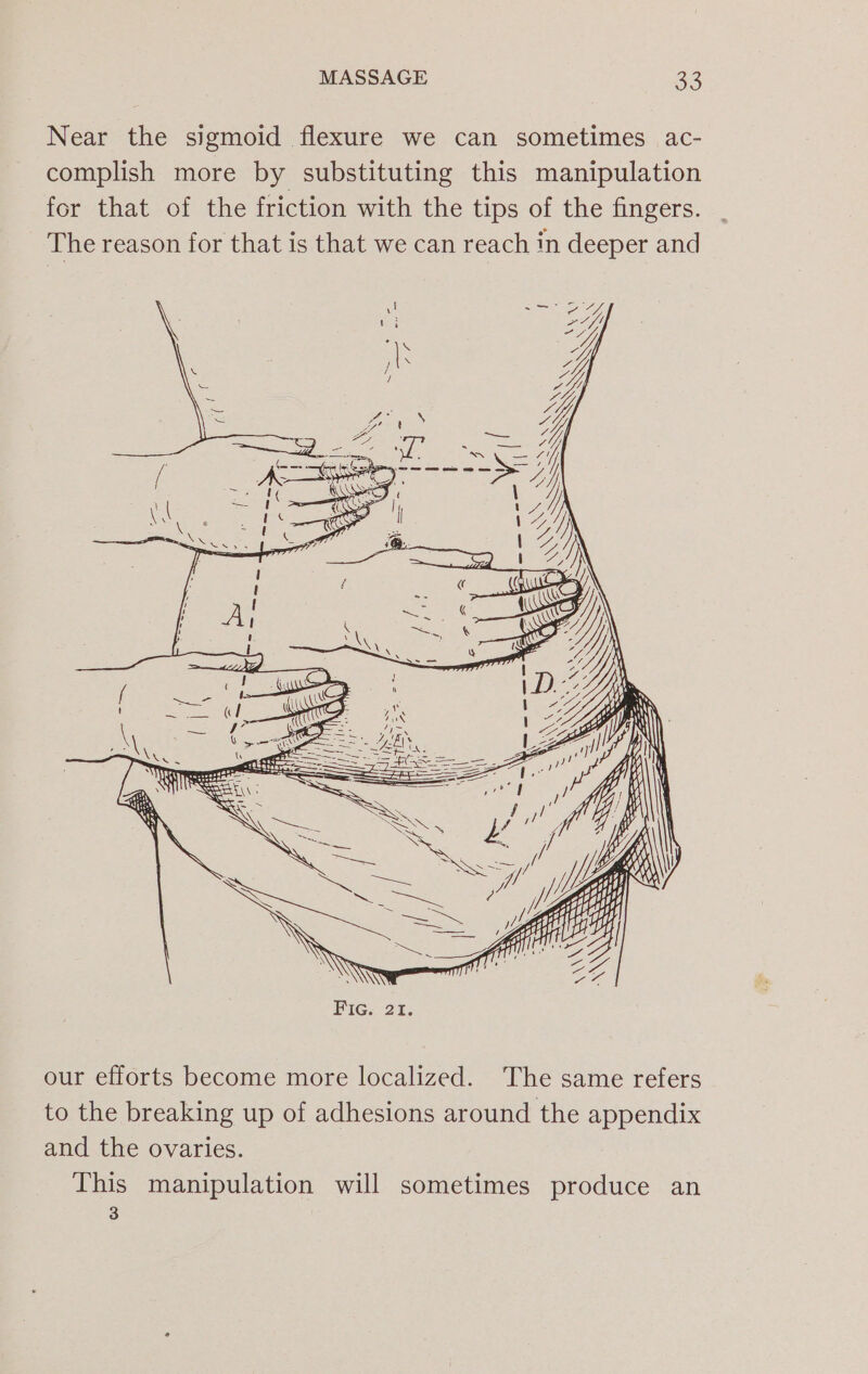 Near the sigmoid flexure we can sometimes ac- complish more by substituting this manipulation for that of the friction with the tips of the fingers. The reason for that is that we can reach in deeper and our efforts become more localized. The same refers to the breaking up of adhesions around the appendix and the ovaries. This manipulation will sometimes produce an 3