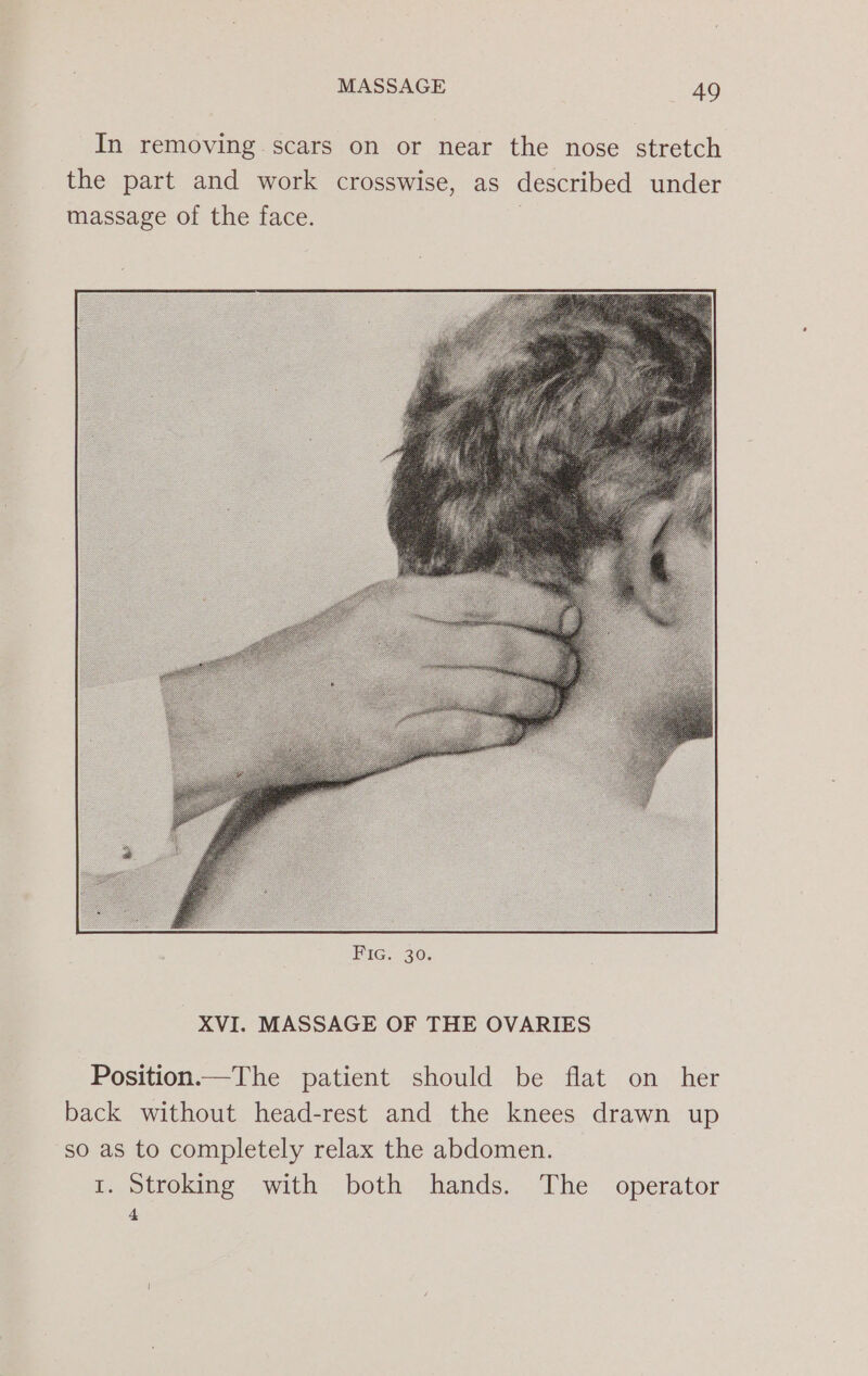 In removing scars on or near the nose stretch the part and work crosswise, as described under massage of the face. 3 XVI. MASSAGE OF THE OVARIES Position.—The patient should be flat on her back without head-rest and the knees drawn up so as to completely relax the abdomen. r. Stroking with both hands. The operator 4
