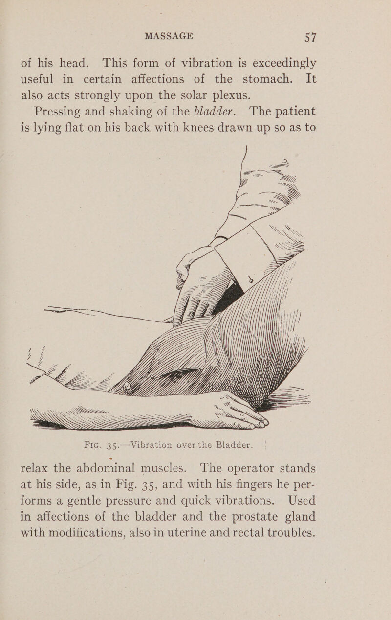 of his head. This form of vibration is exceedingly useful in certain affections of the stomach. It also acts strongly upon the solar plexus. Pressing and shaking of the bladder. The patient is lying flat on his back with knees drawn up so as to 1 relax the abdominal muscles. The operator stands at his side, as in Fig. 35, and with his fingers he per- forms a gentle pressure and quick vibrations. Used in affections of the bladder and the prostate gland with modifications, also in uterine and rectal troubles.