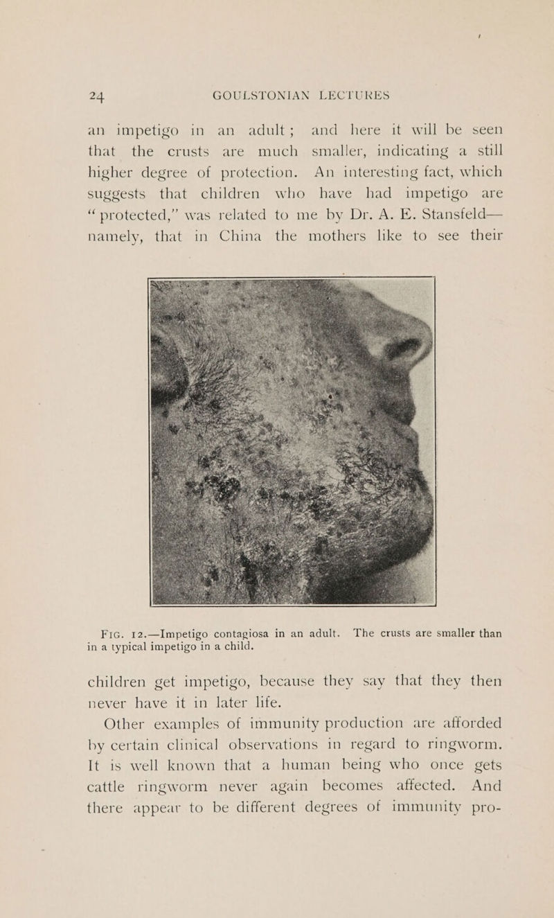 an impetigo in an adult; and here it will be seen that the crusts are much smaller, indicating a still higher degree of protection. An interesting fact, which suggests that children who have had impetigo are “protected,” was related to me by Dr. A. E. Stansfeld— namely, that in China the mothers like to see their Fic. 12.—Impetigo contagiosa in an adult. The crusts are smaller than in a typical impetigo in a child. children get impetigo, because they say that they then never have it in later life. Other examples of immunity production are aftorded by certain clinical observations in regard to ringworm. It is well known that a human being who once gets cattle ringworm never again becomes affected. And there appear to be different degrees of immunity pro-