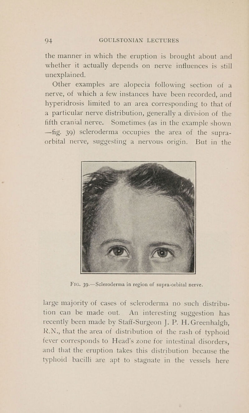 the manner in which the eruption is brought about and whether it actually depends on nerve influences is still unexplained. Other examples are alopecia following section of a nerve, of which a few instances have been recorded, and hyperidrosis limited to an area corresponding to that of a particular nerve distribution, generally a division of the fifth cranial nerve. Sometimes (as in the example shown —fig. 39) scleroderma occupies the area of the supra- orbital nerve, suggesting a nervous origin. But in the FIG. 39.—Scleroderma in region of supra-orbital nerve. large majority of cases of scleroderma no such distribu- tion can be made out. An interesting suggestion has recently been made by Staff-Surgeon J]. P. H. Greenhalgh, K.N., that the area of distribution of the rash of typhoid fever corresponds to Head’s zone for intestinal disorders, and that the eruption takes this distribution because the typhoid bacilli are apt to stagnate in the vessels here