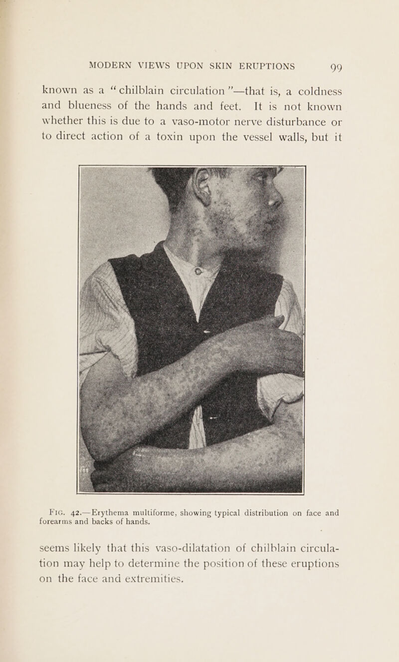 known as a “chilblain circulation ”’—that is, a coldness and blueness of the hands and feet. It is not known whether this is due to a vaso-motor nerve disturbance or to direct action of a toxin upon the vessel walls, but it Fic. 42.—Erythema multiforme, showing typical distribution on face and forearms and backs of hands. seems likely that this vaso-dilatation of chilblain circula- tion may help to determine the position of these eruptions on the face and extremities.