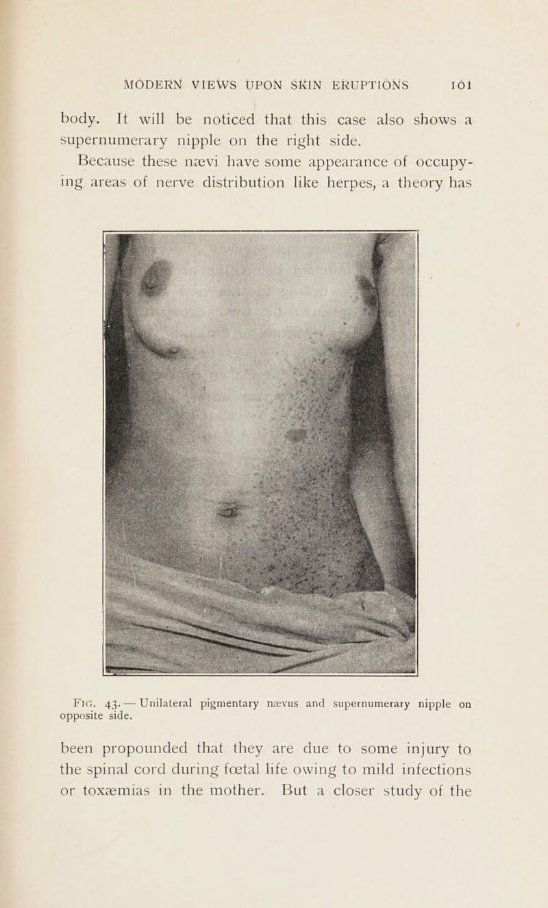 body. It will be noticed that this case also shows a supernumerary nipple on the right side. Because these nevi have some appearance of occupy- ing areas of nerve distribution like herpes, a theory has Fic. 43.— Unilateral pigmentary neevus and supernumerary nipple on opposite side. been propounded that they are due to some injury to the spinal cord during foetal life owing to mild infections or toxeemias in the mother. But a closer study of the