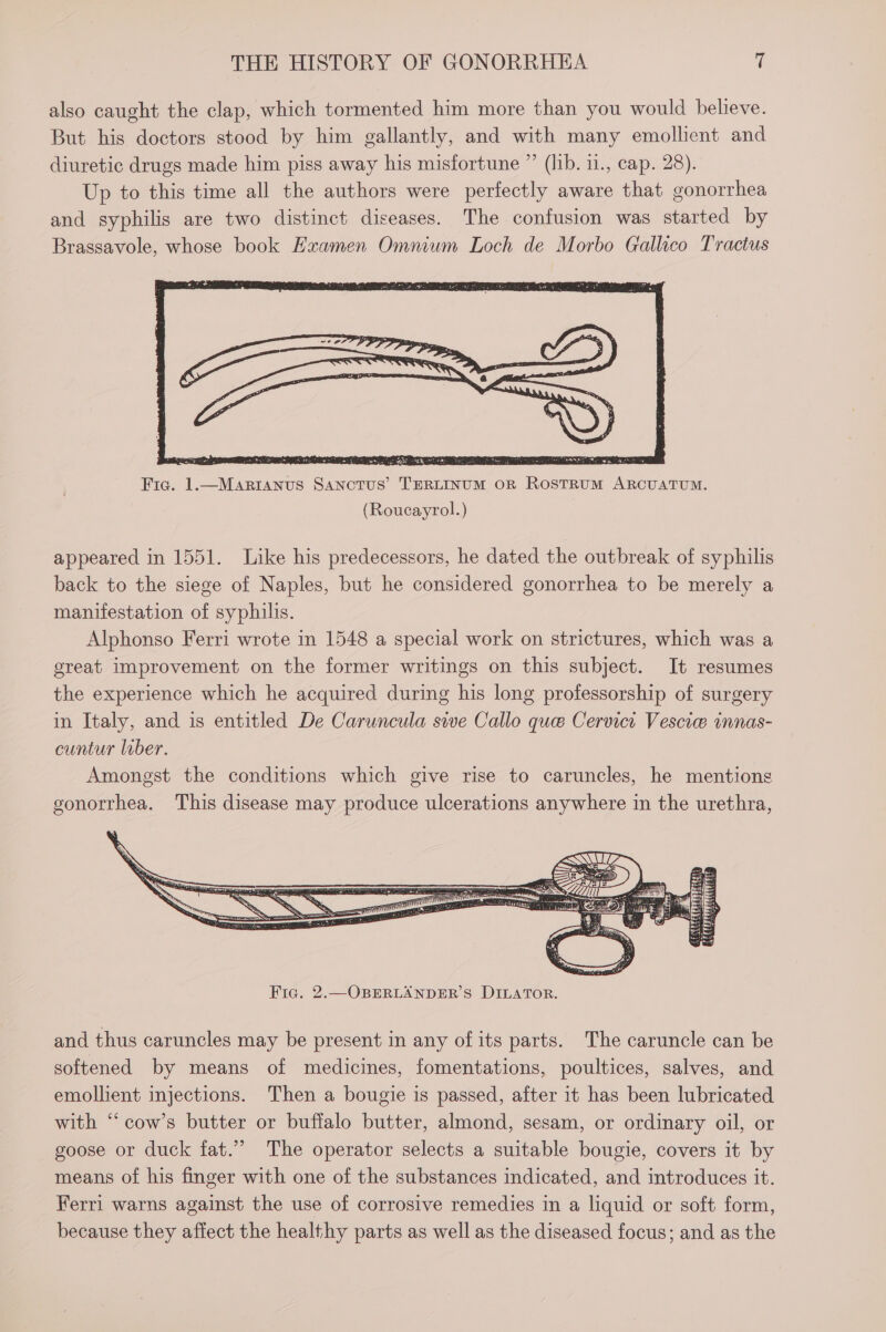 also caught the clap, which tormented him more than you would believe. But his doctors stood by him gallantly, and with many emollient and diuretic drugs made him piss away his misfortune ” (lib. 11., cap. 28). Up to this time all the authors were perfectly aware that gonorrhea and syphilis are two distinct diseases. The confusion was started by Brassavole, whose book Hxamen Omnium Loch de Morbo Gallico Tractus - - . : Snail) «= eG Se ae Ct eeiee,) SS Rae SP Rdg 1p 2 So Reais TS ae emer Fia. 1.—MariAnus Sanotus’ TERLINUM OR ROSTRUM ARCUATUM. (Roucayrol.) appeared in 1551. Like his predecessors, he dated the outbreak of syphilis back to the siege of Naples, but he considered gonorrhea to be merely a manifestation of syphilis. Alphonso Ferri wrote in 1548 a special work on strictures, which was a great improvement on the former writings on this subject. It resumes the experience which he acquired during his long professorship of surgery in Italy, and is entitled De Caruncula sive Callo que Cervici Vescie innas- cuntur lober. Amongst the conditions which give rise to caruncles, he mentions gonorrhea. This disease may produce ulcerations anywhere in the urethra, and thus caruncles may be present in any of its parts. The caruncle can be softened by means of medicines, fomentations, poultices, salves, and emollient injections. Then a bougie is passed, after it has been lubricated with “‘ cow’s butter or buffalo butter, almond, sesam, or ordinary oil, or goose or duck fat.”” The operator selects a suitable bougie, covers it by means of his finger with one of the substances indicated, and introduces it. Ferri warns against the use of corrosive remedies in a liquid or soft form, because they affect the healthy parts as well as the diseased focus; and as the