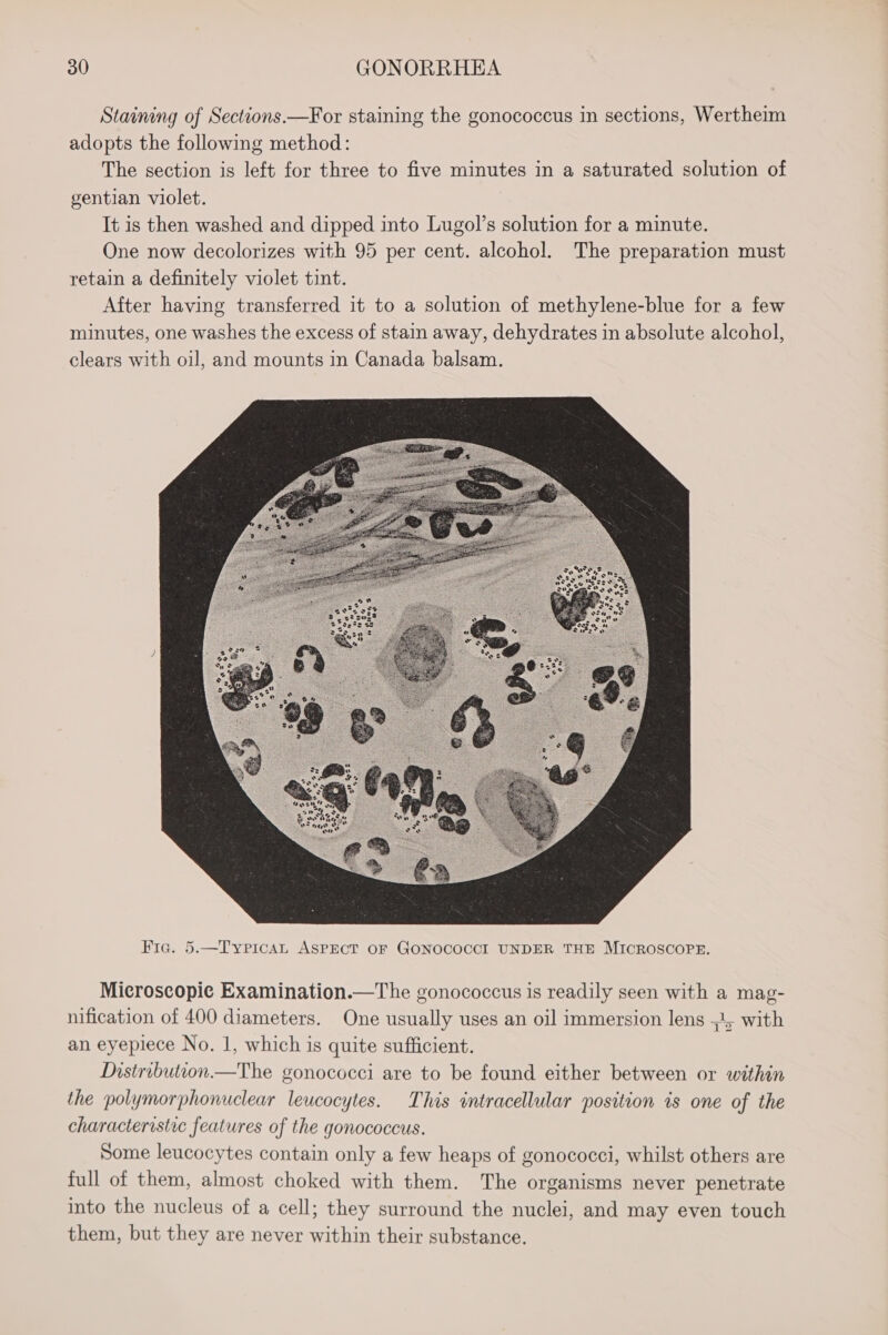 Staining of Sections.—For staining the gonococcus in sections, Wertheim adopts the following method: The section is left for three to five minutes in a saturated solution of gentian violet. It is then washed and dipped into Lugol’s solution for a minute. One now decolorizes with 95 per cent. alcohol. The preparation must retain a definitely violet tint. After having transferred it to a solution of methylene-blue for a few minutes, one washes the excess of stain away, dehydrates in absolute alcohol, clears with oil, and mounts in Canada balsam. Fie. 5.—Typicat ASPECT oF GONOCOCCI UNDER THE MICROSCOPE. Microscopie Examination.—The gonococcus is readily seen with a mag- nification of 400 diameters. One usually uses an oil immersion lens 54, with an eyepiece No. 1, which is quite sufficient. Distribution —The gonococci are to be found either between or within the polymorphonuclear leucocytes. This intracellular position is one of the characteristic features of the gonococcus. Some leucocytes contain only a few heaps of gonococci, whilst others are full of them, almost choked with them. The organisms never penetrate into the nucleus of a cell; they surround the nuclei, and may even touch them, but they are never within their substance.