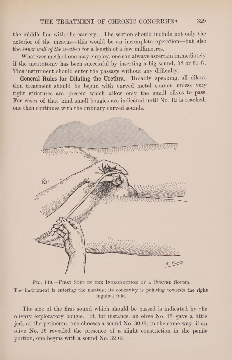 the middle line with the cautery. The section should include not only the exterior of the meatus—this would be an incomplete operation—but also the «nner wall of the urethra for a length of a few millimetres. Whatever method one may employ, one can always ascertain immediately if the meatotomy has been successful by inserting a big sound, 58 or 60 G. This instrument should enter the passage without any difficulty. General Rules for Dilating the Urethra.—Broadly speaking, all dilata- tion treatment should be begun with curved metal sounds, unless very tight strictures are present which allow only the small olives to pass. For cases of that kind small bougies are indicated until No. 12 is reached, one then continues with the ordinary curved sounds. SSA SN ae ite ; Cae yy. . fe De Ne Noe on ZL EON NN AAA anak Ps NG ASRAAAAANY M \ ARR \ y ae Fig. 149.—First Strr IN THE INTRODUCTION OF A CURVED SOUND. The instrument is entering the meatus; its concavity is pointing towards the right inguinal] fold. The size of the first sound which should be passed is indicated by the olivary exploratory bougie. If, for instance, an olive No. 15 gave a little jerk at the permeum, one chooses a sound No. 30 G; in the same way, if an olive No. 16 revealed the presence of a slight constriction in the penile portion, one begins with a sound No. 32 G.