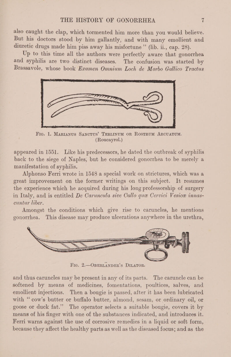 also caught the clap, which tormented him more than you would believe. But his doctors stood by him gallantly, and with many emollient and diuretic drugs made him piss away his misfortune ” (lib. ii., cap. 28). Up to this time all the authors were perfectly aware that gonorrhea and syphilis are two distinct diseases. The confusion was started by Brassavole, whose book Examen Omnium Loch de Morbo Gallico Tractus PT Cee tek Fic. 1. Martanus Sanctus’ TERLINUM OR ROSTRUM ARCUATUM. (Roucayrol.) appeared in 1551. Like his predecessors, he dated the outbreak of syphilis back to the siege of Naples, but he considered gonorrhea to be merely a manifestation of syphilis. Alphonso Ferri wrote in 1548 a special work on strictures, which was a great improvement on the former writings on this subject. It resumes the experience which he acquired during his long professorship of surgery in Italy, and is entitled De Caruncula sive Callo que Cervict Vesicæ innas- cuntur liber. | Amongst the conditions which give rise to caruncles, he mentions gonorrhea. This disease may produce ulcerations anywhere in the urethra, and thus caruncles may be present in any of its parts. The caruncle can be softened by means of medicines, fomentations, poultices, salves, and emollient injections. Then a bougie is passed, after it has been lubricated with “ cow’s butter or buffalo butter, almond, sesam, or ordinary oil, or _ goose or duck fat.” The operator selects a suitable bougie, covers it by means of his finger with one of the substances indicated, and introduces it. Ferri warns against the use of corrosive remedies in a liquid or soft form, because they affect the healthy parts as well as the diseased focus; and as the