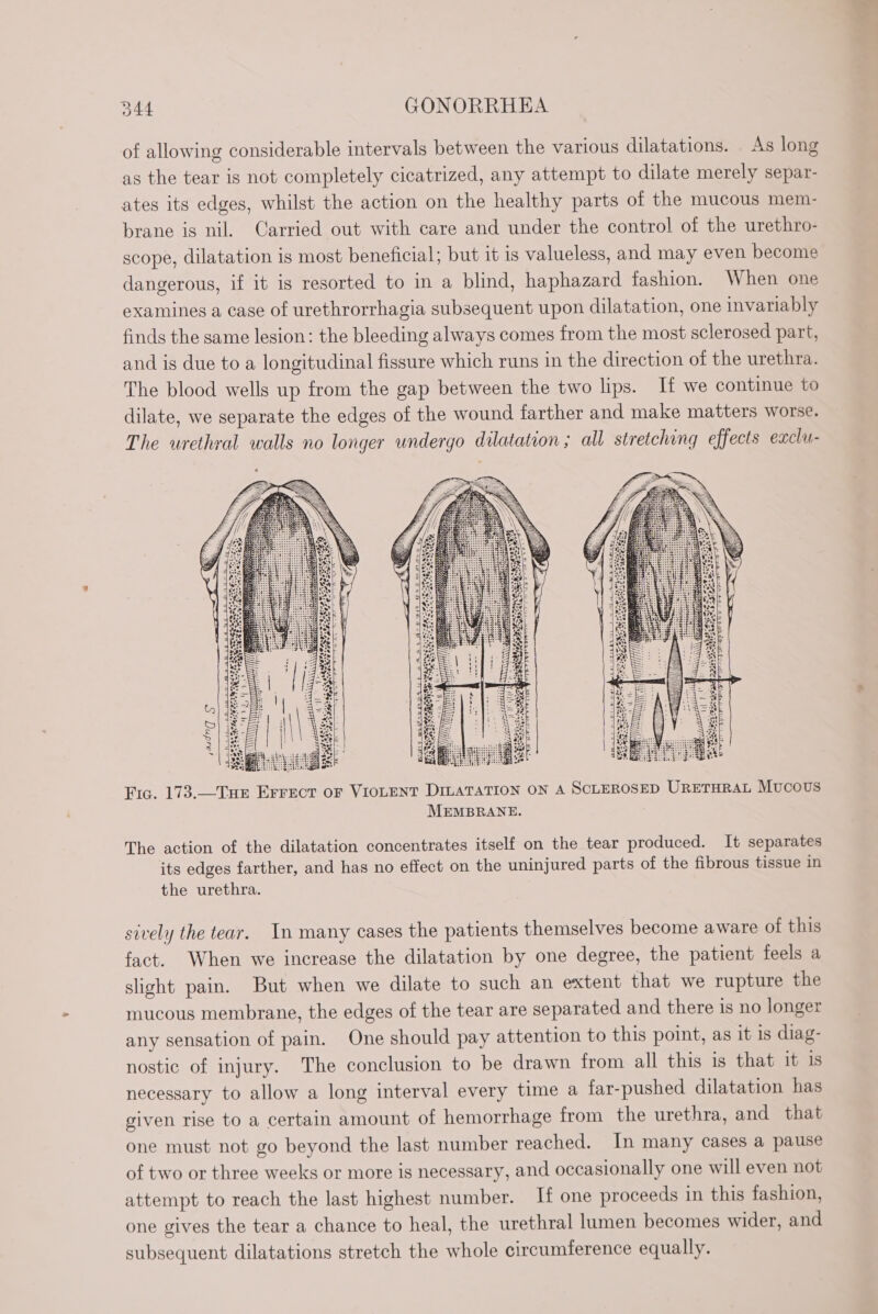 of allowing considerable intervals between the various dilatations. As long as the tear is not completely cicatrized, any attempt to dilate merely separ- ates its edges, whilst the action on the healthy parts of the mucous mem- brane is nil. Carried out with care and under the control of the urethro- scope, dilatation is most beneficial; but it is valueless, and may even become dangerous, if it is resorted to in a blind, haphazard fashion. When one examines a case of urethrorrhagia subsequent upon dilatation, one invariably finds the same lesion: the bleeding always comes from the most sclerosed part, and is due to a longitudinal fissure which runs in the direction of the urethra. The blood wells up from the gap between the two lips. If we continue to dilate, we separate the edges of the wound farther and make matters worse. The urethral walls no longer undergo dilatation ; all stretching effects exclu- Fig. 173.—THE EFFECT oF VIOLENT DILATATION ON A ScLEROSED URETHRAL Mucous MEMBRANE. The action of the dilatation concentrates itself on the tear produced. It separates its edges farther, and has no effect on the uninjured parts of the fibrous tissue in the urethra. sively the tear. In many cases the patients themselves become aware of this fact. When we increase the dilatation by one degree, the patient feels a slight pain. But when we dilate to such an extent that we rupture the mucous membrane, the edges of the tear are separated and there is no longer any sensation of pain. One should pay attention to this point, as it is diag- nostic of injury. The conclusion to be drawn from all this is that it is necessary to allow a long interval every time a far-pushed dilatation has given rise to a certain amount of hemorrhage from the urethra, and that one must not go beyond the last number reached. In many cases a pause of two or three weeks or more is necessary, and occasionally one will even not attempt to reach the last highest number. It one proceeds in this fashion, one gives the tear a chance to heal, the urethral lumen becomes wider, and subsequent dilatations stretch the whole circumference equally.