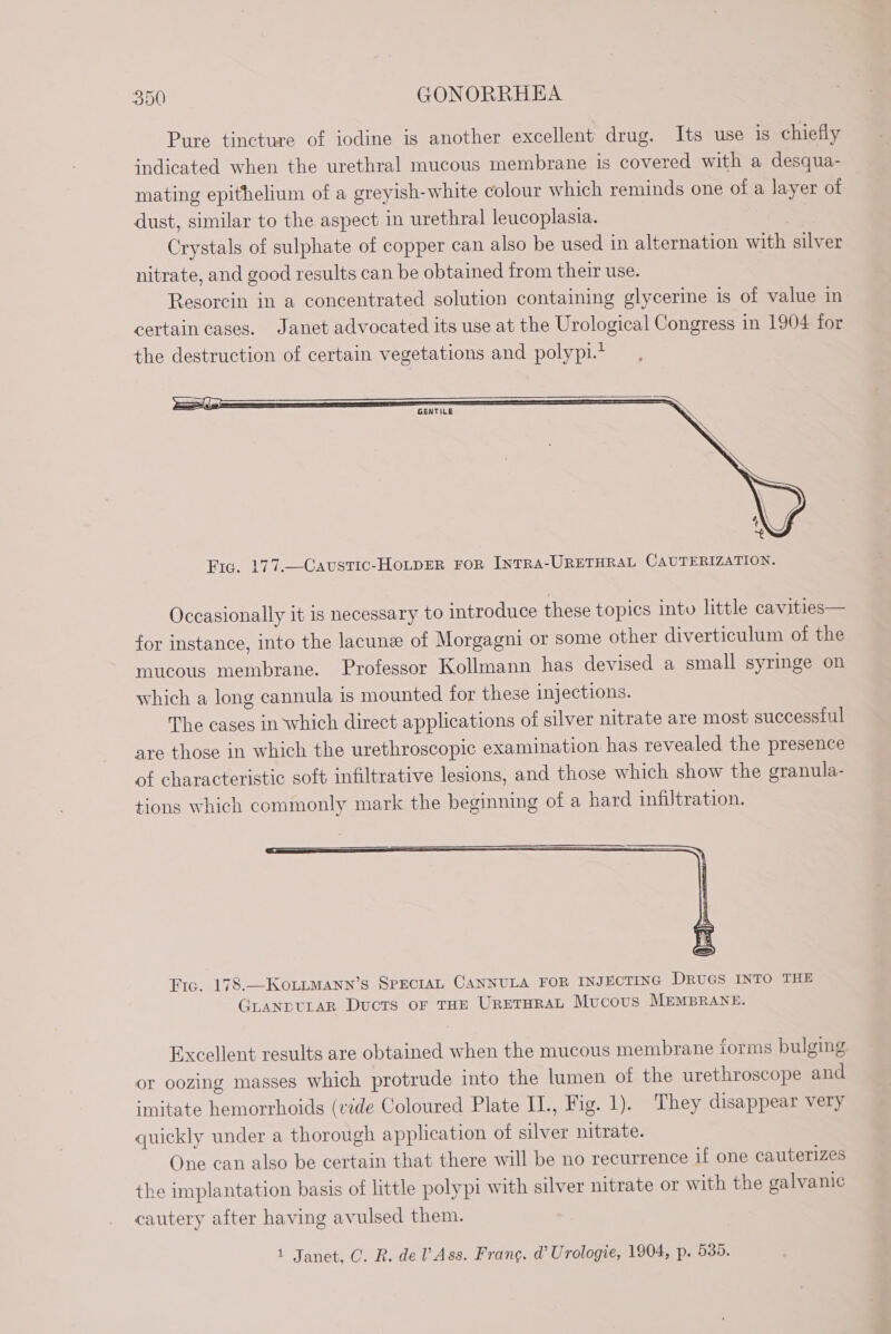 Pure tincture of iodine is another excellent drug. Its use is chiefly indicated when the urethral mucous membrane is covered with a desqua- mating epithelium of a greyish-white colour which reminds one of a layer of dust, similar to the aspect in urethral leucoplasia. Crystals of sulphate of copper can also be used in alternation with silver nitrate, and good results can be obtained from their use. Resorcin in a concentrated solution containing glycerine is of value in certain cases. Janet advocated its use at the Urological Congress in 1904 for the destruction of certain vegetations and polypi.* GENTILE Fic. 177.—Caustic-HoLpER FOR INTRA-URETHRAL CAUTERIZATION. Occasionally it is necessary to introduce these topics into little cavities— for instance, into the lacunæ of Morgagni or some other diverticulum of the mucous membrane. Professor Kollmann has devised a small syringe on which a long cannula is mounted for these injections. The cases in which direct applications of silver nitrate are most successful are those in which the urethroscopic examination has revealed the presence of characteristic soft infiltrative lesions, and those which show the granula- tions which commonly mark the beginning of a hard infiltration. Fic. 178.—KoOLLMANN’S SPECIAL CANNULA FOR INJECTING DRUGS INTO THE GLANDULAR Ducts OF THE URETHRAL Mucous MEMBRANE. Excellent results are obtained when the mucous membrane forms bulging or oozing masses which protrude into the lumen of the urethroscope and imitate hemorrhoids (vide Coloured Plate IL., Fig. 1). They disappear very quickly under a thorough application of silver nitrate. One can also be certain that there will be no recurrence if one cauterizes the implantation basis of little polypi with silver nitrate or with the galvanic cautery after having avulsed them.