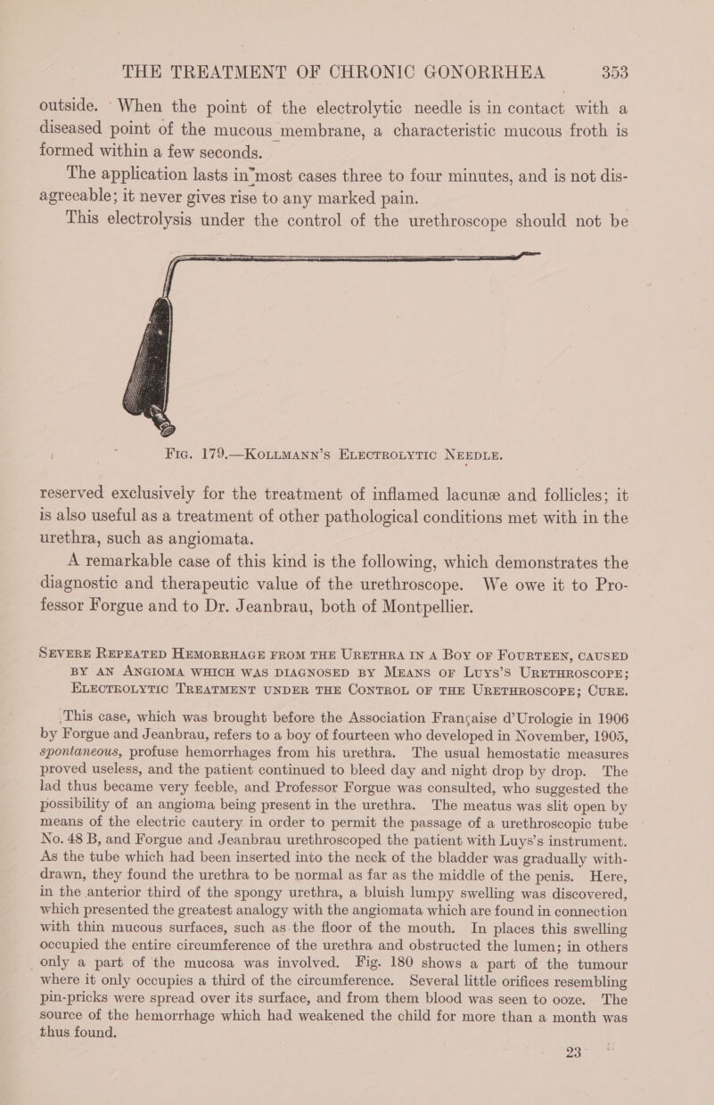 outside. “When the point of the electrolytic needle is in contact with a diseased point of the mucous membrane, a characteristic mucous froth is formed within a few seconds. — The application lasts inmost cases three to four minutes, and is not dis- agreeable; it never gives rise to any marked pain. This electrolysis under the control of the urethroscope should not be reserved exclusively for the treatment of inflamed lacunæ and follicles; it is also useful as a treatment of other pathological conditions met with in the urethra, such as angiomata. A remarkable case of this kind is the following, which demonstrates the diagnostic and therapeutic value of the urethroscope. We owe it to Pro- fessor Forgue and to Dr. Jeanbrau, both of Montpellier. SEVERE REPEATED HEMORRHAGE FROM THE URETHRA IN A Boy OF FOURTEEN, CAUSED BY AN ANGIOMA WHICH WAS DIAGNOSED BY MEANS or Luys’S URETHROSCOPE: ELECTROLYTIC TREATMENT UNDER THE CONTROL OF THE URETHROSCOPE; CURE. This case, which was brought before the Association Francaise d’Urologie in 1906 by Forgue and Jeanbrau, refers to a boy of fourteen who developed in November, 1905, spontaneous, profuse hemorrhages from his urethra. The usual hemostatic measures proved useless, and the patient continued to bleed day and night drop by drop. The lad thus became very feeble, and Professor Forgue was consulted, who suggested the possibility of an angioma being present in the urethra. The meatus was slit open by means of the electric cautery in order to permit the passage of a urethroscopic tube No. 48 B, and Forgue and Jeanbrau urethroscoped the patient with Luys’s instrument. As the tube which had been inserted into the neck of the bladder was gradually with- drawn, they found the urethra to be normal as far as the middle of the penis. Here, in the anterior third of the spongy urethra, a bluish lumpy swelling was discovered, which presented the greatest analogy with the angiomata which are found in connection with thin mucous surfaces, such as.the floor of the mouth. In places this swelling occupied the entire circumference of the urethra and obstructed the lumen; in others only a part of the mucosa was involved. Fig. 180 shows a part of the tumour where it only occupies a third of the circumference. Several little orifices resembling pin-pricks were spread over its surface, and from them blood was seen to ooze. The source of the hemorrhage which had weakened the child for more than a month was _ thus found. 23