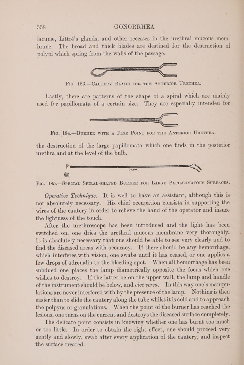 lacune, Littré’s glands, and other recesses in the urethral mucous mem- brane. The broad and thick blades are destined for the destruction of polypi which spring from the walls of the passage. Fic. 183.— CAUTERY BLADE FOR THE ANTERIOR URETHRA. Lastly, there are patterns of the shape of a spiral which are mainly used fer papillomata of a certain size. They are especially intended for SSS TTS ea Fic. 184.—BURNER WITH A FINE POINT FOR THE ANTERIOR URETHRA. the destruction of the large papillomata which one finds in the posterior urethra and at the level of the bulb. COLLIN à ù © Fic. 185.-— SPECIAL SPIRAL-SHAPED BURNER FOR LARGE PAPILLOMATOUS SURFACES. Operative Technique.—It is well to have an assistant, although this is not absolutely necessary. His chief occupation consists in supporting the wires of the cautery in order to relieve the hand of the operator and insure the lightness of the touch. After the urethroscope has been introduced and the light has been switched on, one dries the urethral mucous membrane very thoroughly. It is absolutely necessary that one should be able to see verÿ clearly and to find the diseased areas with accuracy. If there should be any hemorrhage, which interferes with vision, one swabs until it has ceased, or one applies a few drops of adrenalin to the bleeding spot. When all hemorrhage has been subdued one places the lamp diametrically opposite the focus which one wishes to destroy. If the latter be on the upper wall, the lamp and handle of the instrument should be below, and vice versa. In this way one’s manipu- lations are never interfered with by the presence of thelamp. Nothing is then easier than to slide the cautery along the tube whilst it is cold and to approach the polpyus or granulations. When the point of the burner has reached the lesions, one turns on the current and destroys the diseased surface completely. The delicate point consists in knowing whether one has burnt too much or too little. In order to obtain the right effect, one should proceed very gently and slowly, swab after every application of the cautery, and inspect the surface treated.