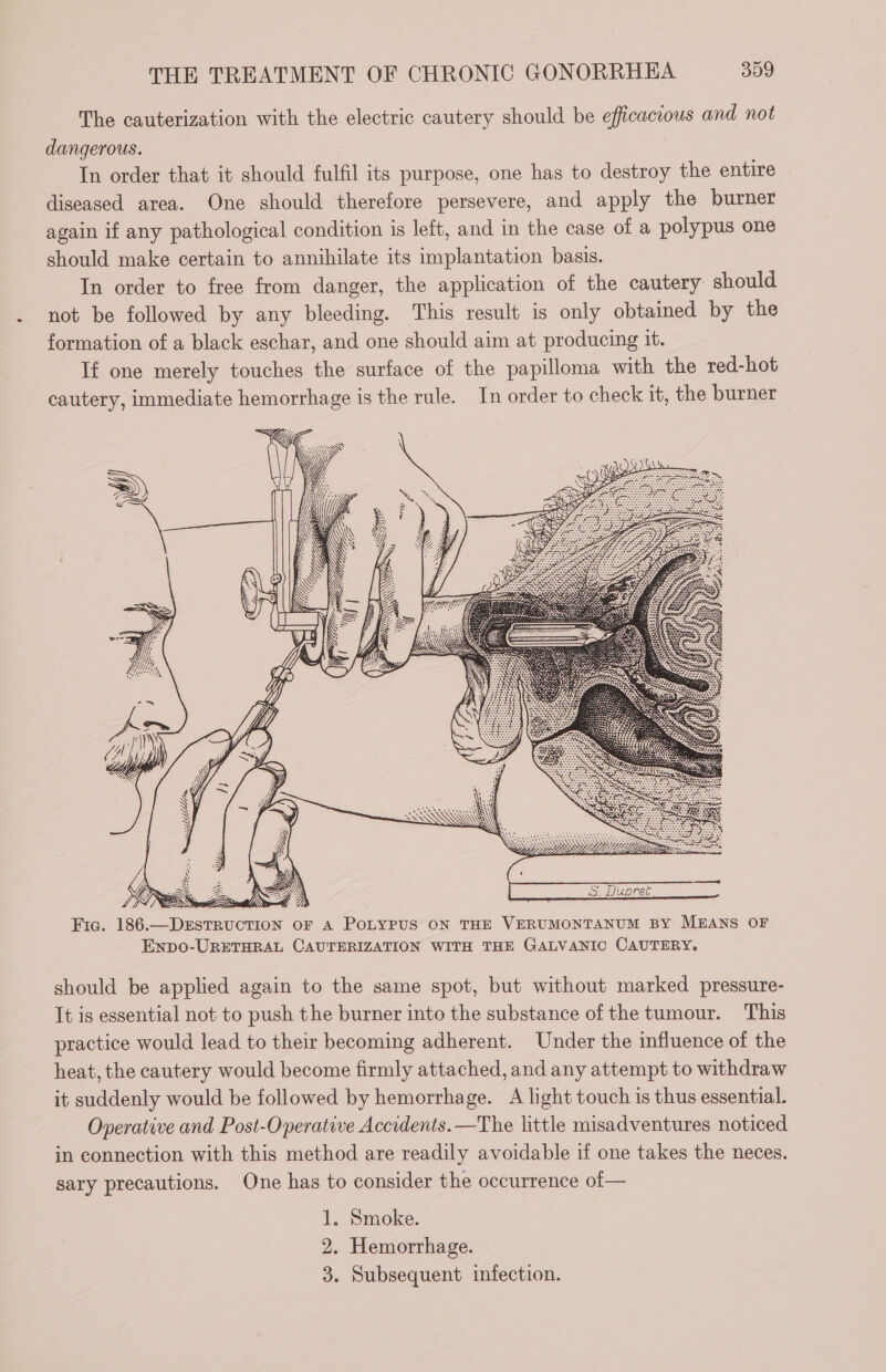 The cauterization with the electric cautery should be efficacious and not dangerous. In order that it should fulfil its purpose, one has to destroy the entire diseased area. One should therefore persevere, and apply the burner again if any pathological condition is left, and in the case of a polypus one should make certain to annihilate its implantation basis. In order to free from danger, the application of the cautery should not be followed by any bleeding. This result is only obtained by the formation of a black eschar, and one should aim at producing it. If one merely touches the surface of the papilloma with the red-hot cautery, immediate hemorrhage is the rule. In order to check it, the burner LIT Votre. ! BY 3 A kK AN = LZ -&lt;N ory iS p ey aN . &amp; LR oe &gt; Nt: 4 Fic. 186.—DESTRUCTION OF A POLYPUS ON THE VERUMONTANUM BY MEANS OF Expo-URETHRAL CAUTERIZATION WITH THE GALVANIC CAUTERY, should be applied again to the same spot, but without marked pressure- It is essential not to push the burner into the substance of the tumour. This practice would lead to their becoming adherent. Under the influence of the heat, the cautery would become firmly attached, and any attempt to withdraw it suddenly would be followed by hemorrhage. A light touch is thus essential. Operative and Post-Operative Accidents. —The little misadventures noticed in connection with this method are readily avoidable if one takes the neces. sary precautions. One has to consider the occurrence of— 1. Smoke. 2. Hemorrhage. 3. Subsequent infection.