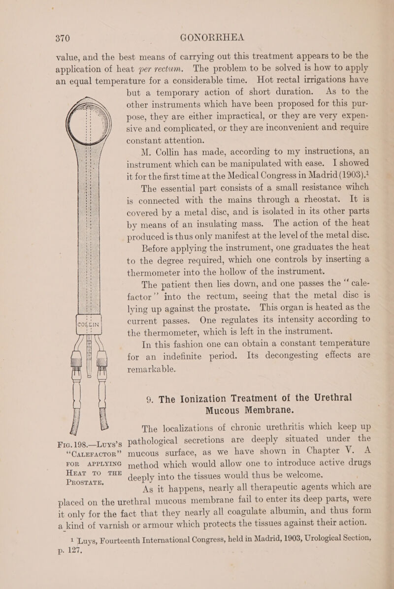 value, and the best means of carrying out this treatment appears to be the application of heat per rectum. The problem to be solved is how to apply an equal temperature for a considerable time. Hot rectal irrigations have but a temporary action of short duration. As to the other instruments which have been proposed for this pur- pose, they are either impractical, or they are very expen- sive and complicated, or they are inconvenient and require constant attention. M. Collin has made, according to my instructions, an instrument which can be manipulated with ease. I showed it for the first time at the Medical Congress in Madrid (1903).* The essential part consists of a small resistance wihch is connected with the mains through a rheostat. It is covered by a metal disc, and is isolated in its other parts by means of an insulating mass. The action of the heat produced is thus only manifest at the level of the metal disc. Before applying the instrument, one graduates the heat to the degree required, which one controls by inserting a thermometer into the hollow of the instrument. The patient then lies down, and one passes the “ cale- factor’’ into the rectum, seeing that the metal disc is lying up against the prostate. This organ is heated as the current passes. One regulates its intensity according to the thermometer, which is left in the instrument. In this fashion one can obtain a constant temperature for an indefinite period. Its decongesting eflects are remarkable. 9. The Ionization Treatment of the Urethral Mucous Membrane. Ee The localizations of chronic urethritis which keep up Frc. 198.—Lvys’s pathological secretions are deeply situated under the “Caceracror” mucous surface, as we have shown in Chapter V. A FOR APPLYING method which would allow one to introduce active drugs es SE bap deeply into the tissues would thus be welcome. ” As it happens, nearly all therapeutic agents which are placed on the urethral mucous membrane fail to enter its deep parts, were it only for the fact that they nearly all coagulate albumin, and thus form a kind of varnish or armour which protects the tissues against their action. 1 Luys, Fourteenth International Congress, held in Madrid, 1903, Urological Section, p. 127,