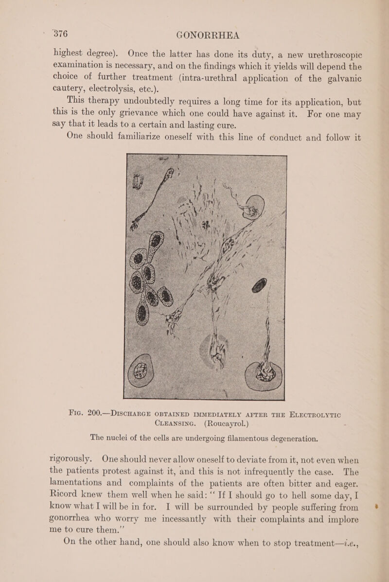 highest degree). Once the latter has done its duty, a new urethroscopic examination is necessary, and on the findings which it yields will depend the choice of further treatment (intra-urethral application of the galvanic cautery, electrolysis, etc.). This therapy undoubtedly requires a long time for its application, but this is the only grievance which one could have against it. For one may say that it leads to a certain and lasting cure. One should familiarize oneself with this line of conduct and follow it Fic. 200.—DIscHARGE OBTAINED IMMEDIATELY AFTER THE ELECTROLYTIC CLEANSING. (Roucayrol.) The nuclei of the cells are undergoing filamentous degeneration. rigorously. One should never allow oneself to deviate from it, not even when the patients protest against it, and this is not infrequently the case. The lamentations and complaints of the patients are often bitter and eager. Ricord knew them well when he said: ‘‘ If I should go to hell some day, I know what I willbe in for. I will be surrounded by people suffering from gonorrhea who worry me incessantly with their complaints and implore me to cure them.” | On the other hand, one should also know when to stop treatment—1.e.,