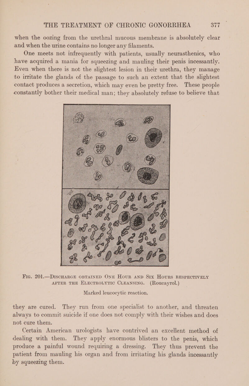 when the oozing from the urethral mucous membrane is absolutely clear and when the urine contains no longer any filaments. One meets not infrequently with patients, usually neurasthenics, who have acquired a mania for squeezing and mauling their penis incessantly. Even when there is not the slightest lesion in their urethra, they manage to irritate the glands of the passage to such an extent that the slightest contact produces a secretion, which may even be pretty free. These people constantly bother their medical man; they absolutely refuse to believe that Fic. 201.—DIscHARGE OBTAINED ONE HOUR AND Six Hours RESPECTIVELY AFTER THE ELECTROLYTIC CLEANSING. (Roucayrol.) Marked leucocytic reaction. they are cured. They run from one specialist to another, and threaten always to commit suicide if one does not comply with their wishes and does not cure them. Certain American urologists have contrived an excellent method of dealing with them. They apply enormous blisters to the penis, which produce a painful wound requiring a dressing. They thus prevent the patient from mauling his organ and from irritating his glands incessantly by squeezing them. |