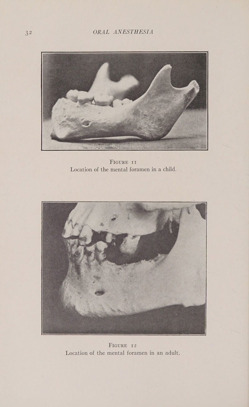 FIGURE II Location of the mental foramen in a ch ild eZ FIGURE ion of the mental foramen dult Wel cehal cl Locat