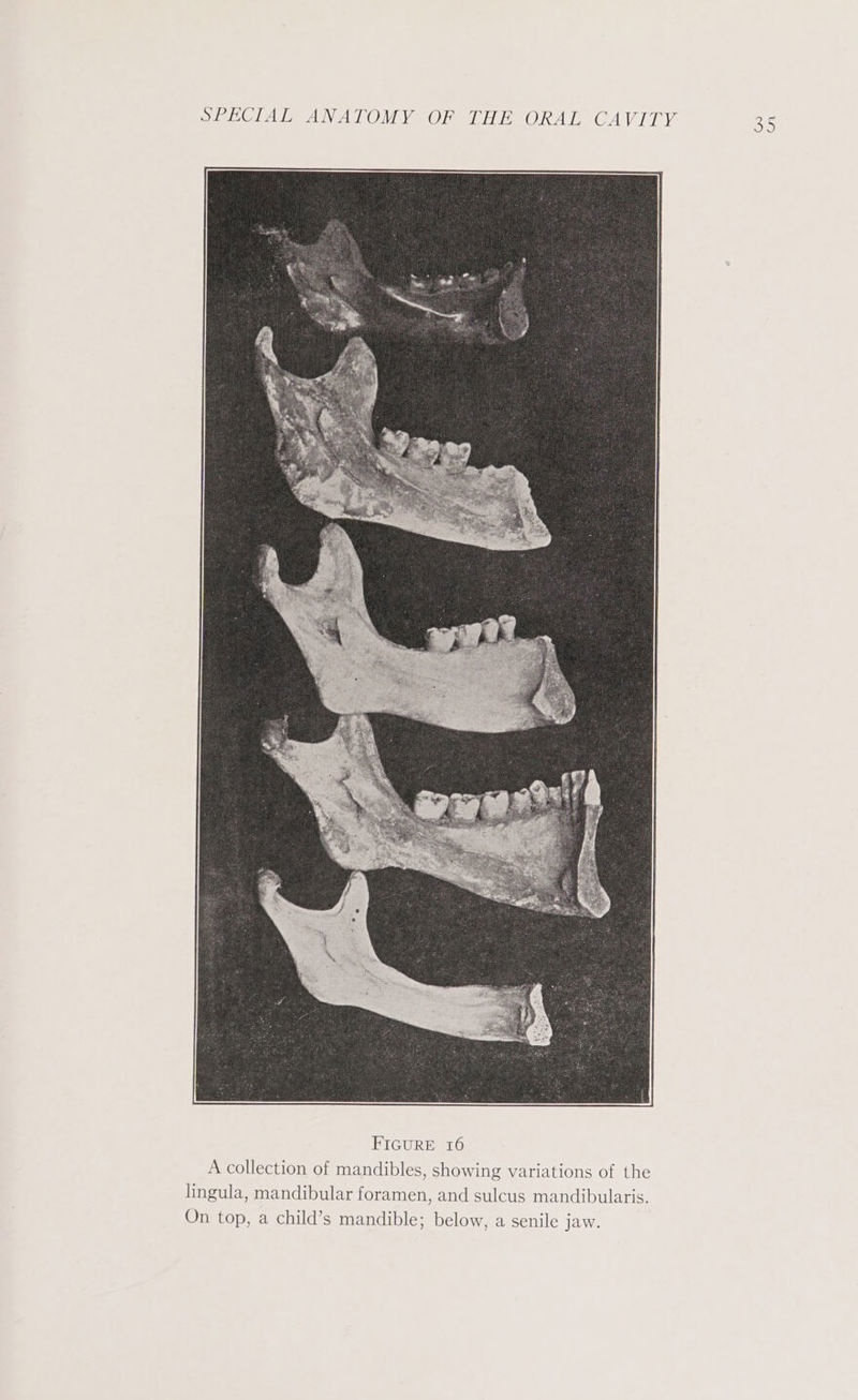 A collection of mandibles, showing variations of the lingula, mandibular foramen, and sulcus mandibularis. On top, a child’s mandible; below, a senile jaw. oo)