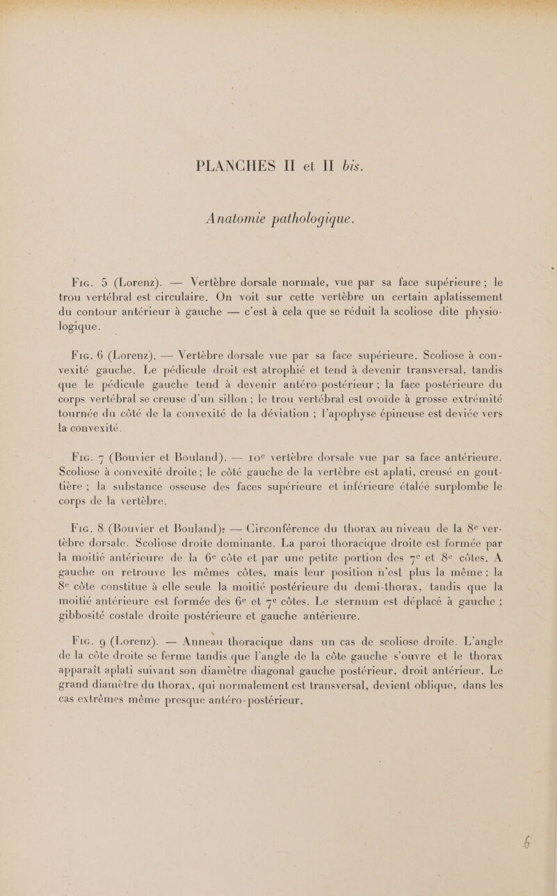 Anatomie pathologique. Fic. 5 (Lorenz). — Vertèbre dorsale normale, vue par sa face supérieure; le trou vertébral est circulaire, On voit sur cette vertèbre un certain aplatissement du contour antérieur à gauche — c’est à cela que se réduit la scoliose dite physio- logique. Fre. 6 (Lorenz). — Vertèbre dorsale vue par sa face supérieure. Scoliose à con- vexité gauche. Le pédicule droit est atrophié et tend à devenir transversal, tandis que le pédicule gauche tend à devenir antéro-postérieur ; la face postérieure du corps vertébral se creuse d’un sillon ; le trou vertébral est ovoide à grosse extrémité tournée du côté de la convexité de la déviation ; l’apophyse épineuse est deviée vers la convexité. Fic. 7 (Bouvier et Bouland). — ro€ vertèbre dorsale vue par sa face antérieure. Scoliose à convexité droite; le côté gauche de la vertèbre est aplati, creusé en gout- tière ; la substance osseuse des faces supérieure et inférieure étalée surplombe le corps de la vertèbre. Fié. 8 (Bouvier et Bouland}: Circonférence du thorax au niveau de la 8e ver- tèbre dorsale. Scoliose droite dominante. La paroi thoracique droite est formée par la moitié antérieure de la 6° côte et par une petite portion des 7° et 8e côtes. À gauche on retrouve les mêmes côtes, mais leur position n’est plus la même: la 8e côte constitue à elle seule la moitié postérieure du demi-thorax, tandis que Ja moitié antérieure est formée des 6e et 7e côtes. Le sternum est déplacé à gauche ; gibbosité costale droite postérieure et gauche antérieure. Fic. 9 (Lorenz). — Anneau thoracique dans un cas de scoliose droite. L’angle de la côte droite se ferme tandis que l’angle de la côte gauche s'ouvre et le thorax apparaît aplati suivant son diamètre diagonal gauche postérieur, droit antérieur. Le grand diamètre du thorax, qui normalement est transversal, devient oblique, dans les cas extrêmes même presque antéro-postérieur,
