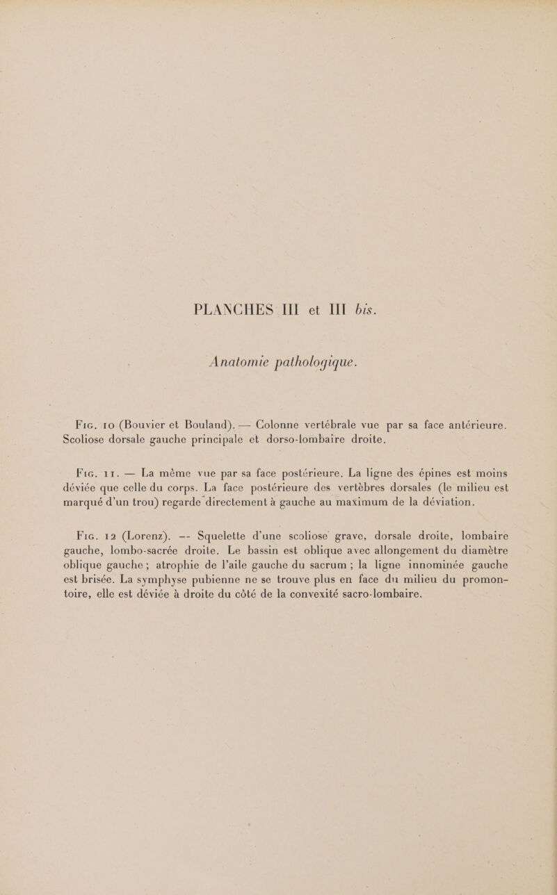 Anatomie pathologique. Fic. 10 (Bouvier et Bouland).— Colonne vertébrale vue par sa face antérieure. Scoliose dorsale gauche principale et dorso-lombaire droite. Fic. 11. — La mème vue par sa face postérieure. La ligne des épines est moins déviée que celle du corps. La face postérieure des vertèbres dorsales (le milieu est marqué d’un trou) regarde directement à gauche au maximum de la déviation. Fic. 12 (Lorenz). -- Squelette d’une scoliose grave, dorsale droite, lombaire gauche, lombo-sacrée droite. Le bassin est oblique avec allongement du diamètre oblique gauche; atrophie de l’aile gauche du sacrum ; la ligne innominée gauche est brisée. La symphyse pubienne ne se trouve plus en face dun milieu du promon- toire, elle est déviée à droite du côté de la convexité sacro-lombaire.