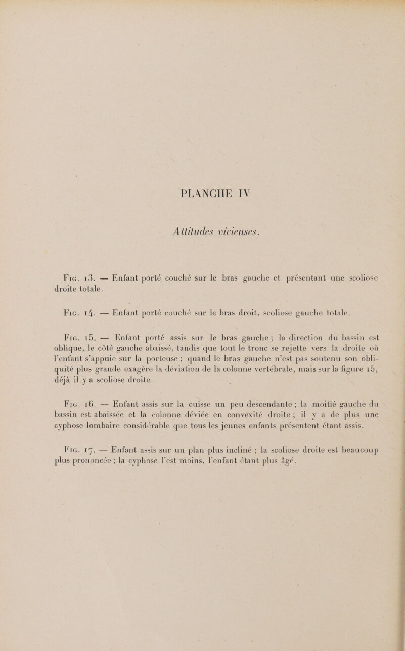 Attitudes vicieuses. Fic. 13. — Enfant porté couché sur le bras gauche et présentant une scoliose droite totale. Fic. 14. — Enfant porté couché sur le bras droit, scoliose gauche totale. F1G. 15. — Enfant porté assis sur le bras gauche; la direction du bassin est oblique, le côté gauche abaissé, tandis que tout le tronc se rejette vers la droite où l'enfant s'appuie sur la porteuse ; quand le bras gauche n’est pas soutenu son obli- quité plus grande exagère la déviation de la colonne vertébrale, mais sur la figure 15, déjà 1l y a scoliose droite. F1G. 16. — Enfant assis sur la cuisse un peu descendante ; la moitié gauche du bassin est abaissée et la colonne déviée en convexité droite ; il y a de plus une cyphose lombaire considérable que tous les jeunes enfants présentent étant assis. Fire. 17. — Enfant assis sur un plan plus incliné ; la scoliose droite est beaucoup lus prononcée ; la cyphose l’est moins, l’enfant étant plus âgé. JI P O Saba. desbe-i