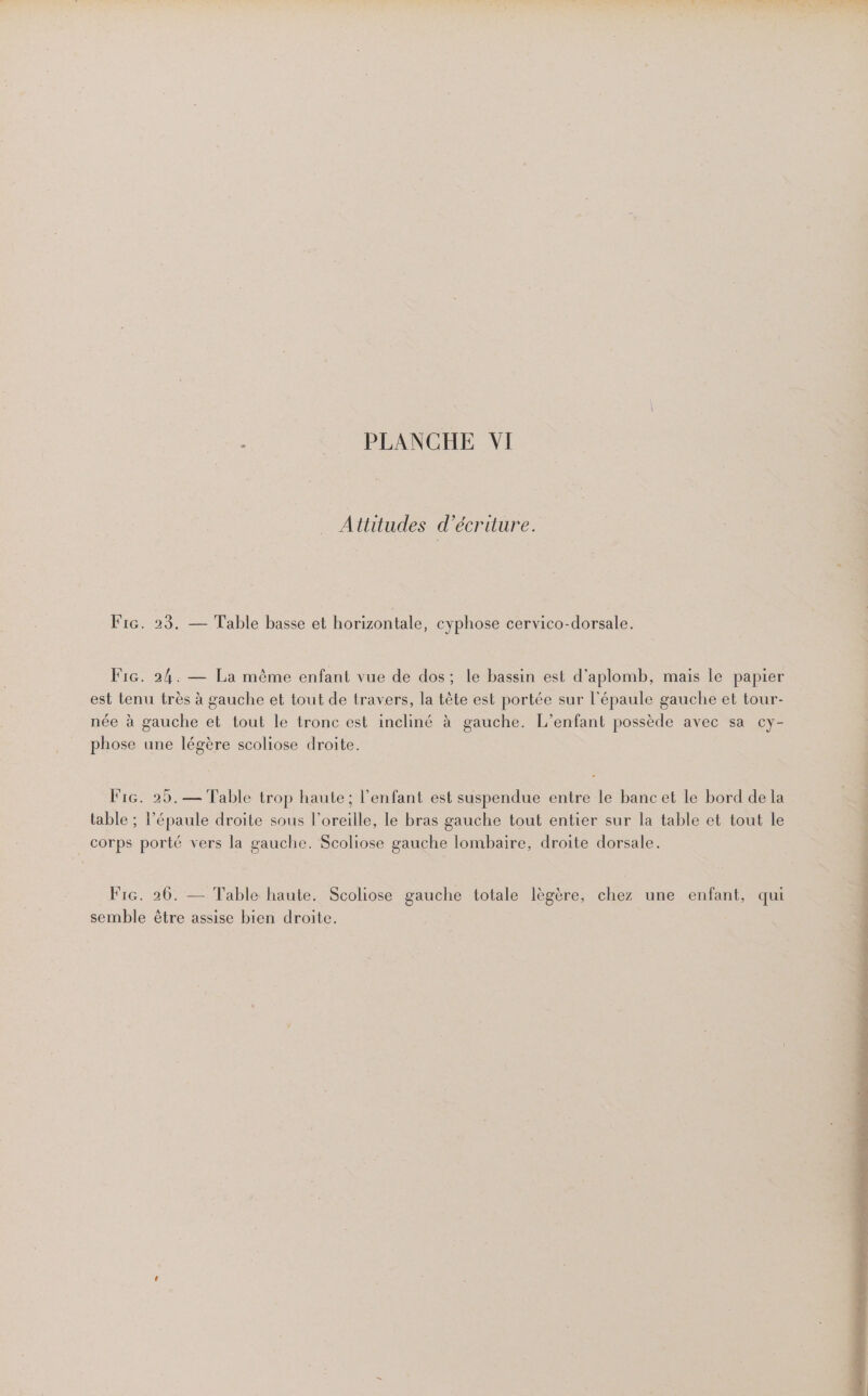 | M AS], 25. PS TOC AERCN STE ; PLANCHE VI Attitudes d ‘écriture. Fire. 23. — Table basse et horizontale, cyphose cervico-dorsale. Fic. 24. — La même enfant vue de dos; le bassin est d’aplomb, mais le papier est tenu très à gauche et tout de travers, la tête est portée sur l'épaule gauche et tour- née à gauche et tout le tronc est incliné à gauche. L'enfant possède avec sa cy- phose une légère scoliose droite. FiG. 25.— Table trop haute; l'enfant est suspendue entre le bancet le bord de la table ; l'épaule droite sous l'oreille, le bras gauche tout entier sur la table et tout le corps porté vers la gauche. Scoliose gauche lombaire, droite dorsale. Fi. 26. — Table haute. Scoliose gauche totale lègère, chez une enfant, qui semble être assise bien droite.