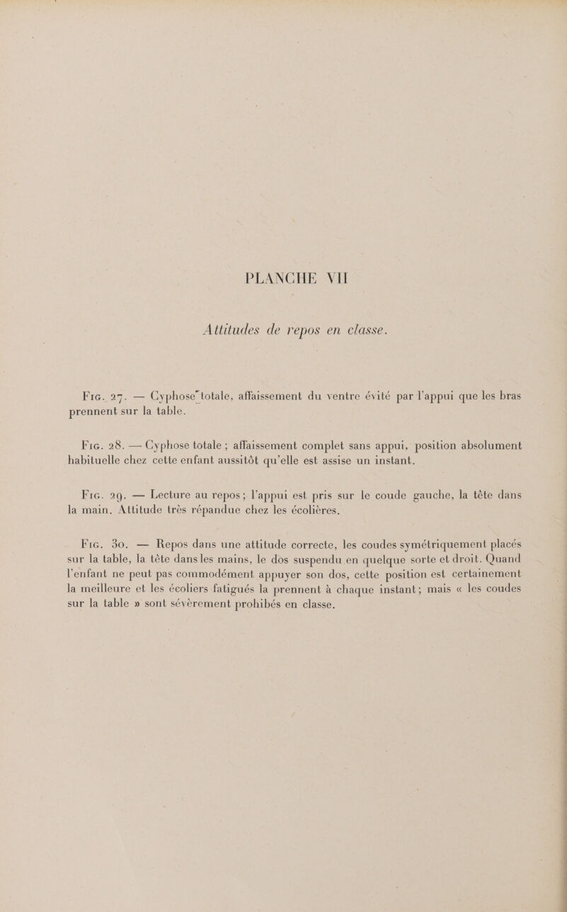 Attitudes de repos en classe. FiG. 27. — Cyphose” totale, affaissement du ventre évité par l'appui que les bras prennent sur la table. Fra. 28. — Cyphose totale ; affaissement complet sans appui, position absolument habituelle chez cette enfant aussitôt qu’elle est assise un instant. Fire. 29. — Lecture au repos ; l’appui est pris sur le coude gauche, la tête dans la main. Attitude très répandue chez les écolières. Fie. 30. — Repos dans une attitude correcte, les coudes symétriquement placés sur la table, la tête dansles mains, le dos suspendu en quelque sorte et droit. Quand l'enfant ne peut pas commodément appuyer son dos, cette position est certainement la meilleure et les écoliers fatigués la prennent à chaque instant; mais « les coudes sur la table » sont sévèrement prohibés en classe.