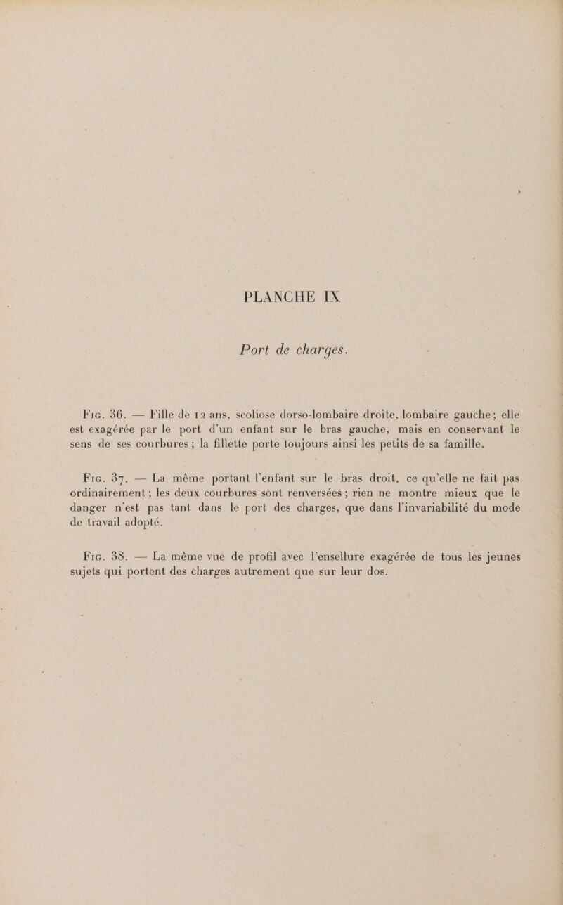 Port de charges. Fic. 36. — Fille de 12 ans, scoliose dorso-lombaire droite, lombaire gauche; elle est exagérée par le port d’un enfant sur le bras gauche, mais en conservant le sens de ses courbures ; la fillette porte toujours ainsi les pelits de sa famille. Fie. 37. — La même portant l'enfant sur le bras droit, ce qu'elle ne fait pas ordinairement ; les deux courbures sont renversées ; rien ne montre mieux que le danger n'est pas tant dans le port des charges, que dans l’invariabilité du mode de travail adopté. Fic. 38. — La même vue de profil avec l’ensellure exagérée de tous les jeunes sujets qui portent des charges autrement que sur leur dos.