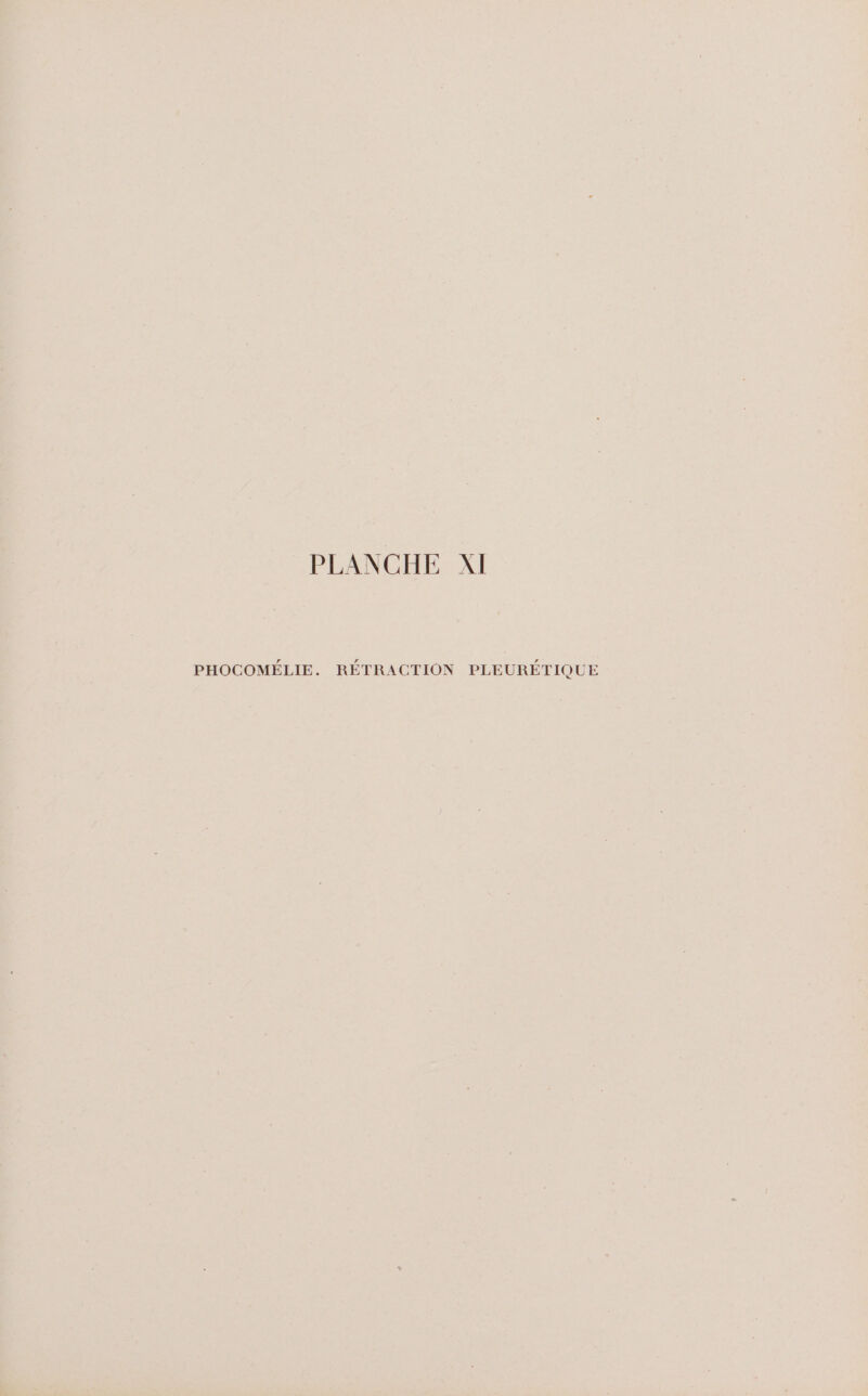 PHOCOMÉLIE. RÉTRACTION PLEURÉTIQUE