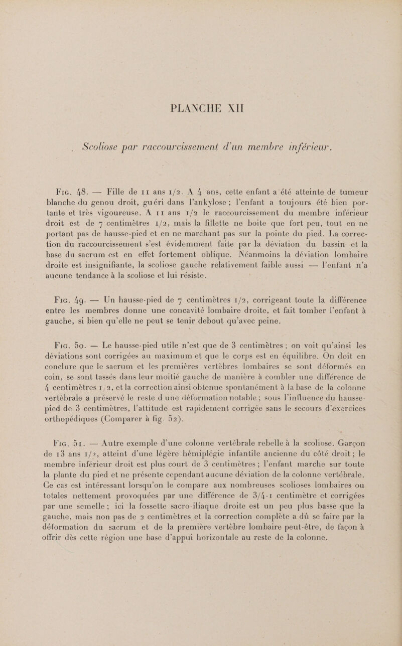 Scoliose par raccourcissement d'un membre inférieur. Fic. 48. — Fille de 11 ans 1/2. À 4 ans, cette enfant a'été atteinte de tumeur blanche du genou droit, guéri dans l’ankyÿlose; l'enfant a toujours été bien por- tante et très vigoureuse. À 11 ans 1/2 le raccourcissement du membre inférieur droit est de 7 centimètres 1/2, mais la fillette ne boite que fort peu, tout en ne portant pas de hausse-pied et en ne marchant pas sur la pointe du pied. La correc- tion du raccourcissement s’est évidemment faite par la déviation du bassin et la base du sacrum est en effet fortement oblique. Néanmoins la déviation lombaire droite est insignifiante, la scoliose gauche relativement faible aussi — l'enfant n’a aucune tendance à la scoliose et lui résiste. Fic. 49. — Un hausse-pied de 7 centimètres 1/2, corrigeant toute la différence entre les membres donne une concavité lombaire droite, et fait tomber l’enfant à gauche, si bien qu’elle ne peut se tenir debout qu'avec peine. Fic. 50. — Le hausse-pied utile n’est que de 3 centimètres ; on voit qu’ainsi les déviations sont corrigées au maximum et que le corps est en équilibre. On doit en conclure que le sacrum et les premières vertèbres lombaires se sont déformés en coin, se sont tassés dans leur moitié gauche de manière à combler une différence de h centimètres 1,2, et la correction ainsi obtenue spontanément à la base de la colonne vertébrale a préservé le reste d une déformation notable ; sous l’influence du hausse- pied de 3 centimètres, l'attitude est rapidement corrigée sans le secours d'exercices orthopédiques (Comparer à fig. 52). Fic. 51. — Autre exemple d’une colonne vertébrale rebelle à la scoliose. Garçon de 13 ans 1/2, atteint d’une légère hémiplégie infantile ancienne du côté droit ; le membre inférieur droit est plus court de 3 centimètres ; l'enfant marche sur toute la plante du pied et ne présente cependant aucune déviation de la colonne vertébrale. Ce cas est intéressant lorsqu'on le compare aux nombreuses scolioses lombaires ou totales nettement provoquées par une différence de 3/4-1 centimètre et corrigées par une semelle; ici la fosselte sacro-iliaque droite est un peu plus basse que la gauche, mais non pas de 2 centimètres et la correction complète a dü se faire par la déformation du sacrum et de la première vertèbre lombaire peut-être, de façon à offrir dès cette région une base d’appui horizontale au reste de la colonne.
