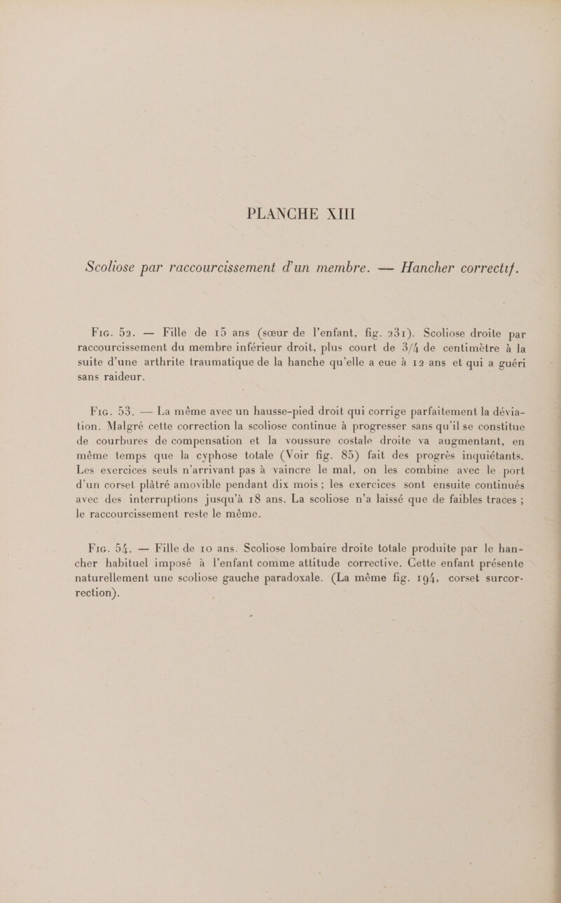 Scoliose par raccourcissement d’un membre. — Hancher correct. Fi. 52. — Fille de 15 ans (sœur de l'enfant, fig. 231). Scoliose droite par raccourcissement du membre inférieur droit, plus court de 3/4 de centimètre à la suite d’une arthrite traumatique de la hanche qu’elle a eue à 12 ans et qui a guéri sans raideur. Fic. 53. — La même avec un hausse-pied droit qui corrige parfaitement la dévia- tion. Malgré cette correction la scoliose continue à progresser sans qu'il se constitue de courbures de compensation et la voussure costale droite va augmentant, en même temps que la cyphose totale (Voir fig. 85) fait des progrès inquiétants. Les exercices seuls n’arrivant pas à vaincre le mal, on les combine avec le port d'un corset plâtré amovible pendant dix mois; les exercices sont ensuite continués avec des interruptions jusqu’à 18 ans. La scoliose n’a laissé que de faibles traces ; le raccourcissement reste le même. F1G6. 54. — Fille de 10 ans. Scoliose lombaire droite totale produite par le han- cher habituel imposé à l'enfant comme attitude corrective. Cette enfant présente naturellement une scoliose gauche paradoxale. (La mème fig. 194, corset surcor- rection).