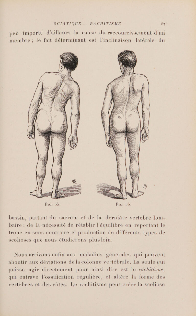 peu importe d'ailleurs la cause du raccourcissement d’un membre ; le fait déterminant est l'inclinaison latérale du bassin, partant du sacrum et de la dernière vertèbre lom- baire ; de 1à nécessité de rétablir l'équilibre en reportant le tronc en sens contraire et production de différents types de scolioses que nous étudierons plus loin. Nous arrivons enfin aux maladies générales qui peuvent aboutir aux déviations de la colonne vertébrale. La seule qui puisse agir directement pour ainsi dire est le rachitisme, qui entrave l’ossification régulière, et altère la forme des vertèbres et des côtes. Le rachitisme peut créer la scoliose