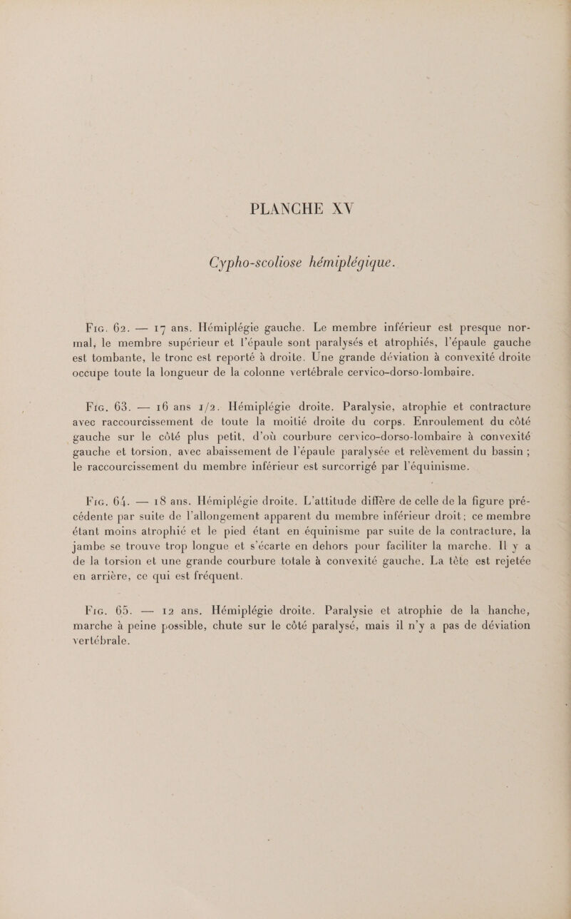 Cypho-scoliose hémiplégique. Fic. 62. — 17 ans. Hémiplégie gauche. Le membre inférieur est presque nor- mal, le membre supérieur et l’épaule sont paralysés et atrophiés, l'épaule gauche est tombante, le tronc est reporté à droite. Une grande déviation à convexité droite occupe toute la longueur de la colonne vertébrale cervico-dorso-lombaire. Fic. 63. — 16 ans 1/2. Hémiplégie droite. Paralysie, atrophie et contracture avec raccourcissement de toute la moitié droite du corps. Enroulement du côté gauche sur le côté plus petit, d’où courbure cervico-dorso-lombaire à convexité gauche et torsion, avec abaissement de l'épaule paralysée et relèvement du bassin ; le raccourcissement du membre inférieur est surcorrigé par l’équinisme. Fire. 64. — 18 ans. Hémiplégie droite. L’attitude diffère de celle de la figure pré- cédente par suite de l’allongement apparent du membre inférieur droit; ce membre étant moins atrophié et le pied étant en équinisme par suite de la contracture, la jambe se trouve trop longue et s’écarte en dehors pour facihter la marche. Il y a de la torsion et une grande courbure totale à convexité gauche. La tète est rejetée en arrière, ce qui est fréquent. Fic. 65. — 12 ans. Hémiplégie droite. Paralysie et atrophie de la hanche, marche à peine possible, chute sur le côté paralysé, mais il n’y a pas de déviation vertébrale.