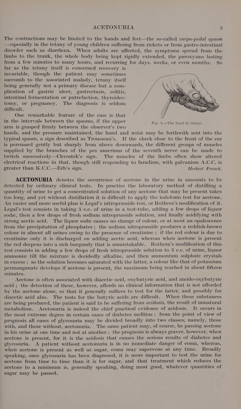 The contractions may be limited to the hands and feet—the so-called carpo-pedal spasm —especially in the tetany of young children suffering from rickets or from gastro-intestinal disorder such as diarrhoea. When adults are affected, the symptoms spread from the limbs to the trunk, the whole body being kept rigidly extended, the paroxysms lasting from a few minutes to many hours, and recurring for days. weeks, or even months. So far as the tetany itself is concerned recovery is invariable, though the patient may sometimes succumb to the associated malady, tetany itself being generally not a primary disease but a com- plication of gastric ulcer, gastrectasis, colitis, intestinal fermentation or putrefaction, thyroidec- tomy, or pregnancy. The diagnosis is seldom difficult. One remarkable feature of the case is that in the intervals between the spasms, if the upper arm is grasped firmly between the observer’s two hands, and the pressure maintained, the hand and wrist may be forthwith sent into the typical spasm, a sign described as Trousseau’s. If the cheek close to the front of the ear is percussed gently but sharply from above downwards, the different groups of muscles supplied by the branches of the pes anserinus of the seventh nerve can be made to twitch successively—Chvostek’s sign. The muscles of the limbs often show altered electrical reactions in that, though still responding to faradism, with galvanism A.C.C. is greater than K.C.C.—Erb’s sign. Herbert French. ACETONURIA denotes the occurrence of acetone in the urine in amounts to be detected by ordinary clinical tests. In practice the laboratory method of distilling a quantity of urine to get a concentrated solution of any acetone that may be present takes too long, and yet without distillation it is difficult to apply the iodoform test for acetone. An easier and more useful plan is Legal’s nitroprusside test, or Rothera’s modification of it. Legal’s test consists in taking 5 c.e. of urine in a test-tube, adding a few drops of liquor sode, then a few drops of fresh sodium nitroprusside solution, and finally acidifying with strong acetic acid. The liquor sod causes no change of colour, or at most an opalescence from the precipitation of phosphates ; the sodium nitroprusside produces a reddish-brown colour in almost all urines owing to the presence of creatinine ; if the red colour is due to creatinine only it is discharged on adding acetic acid, whereas when acetone is present the red deepens into a rich burgundy that is unmistakable. Rothera’s modification of this test consists in adding a few drops of fresh nitroprusside solution to 5 c.c. of urine, liquor ammonie till the mixture is decidedly alkaline, and then ammonium sulphate crystals in excess ; as the solution becomes saturated with the latter, a colour like that of potassium permanganate develops if acetone is present, the maximum being reached in about fifteen minutes. Acetone is often associated with diacetic acid, oxybutyric acid, and amido-oxybutyric acid ; the detection of these, however, affords no clinical information that is not afforded by the acetone alone, so that it generally suffices to test for the latter, and possibly for diacetic acid also. The tests for the butyric acids are difficult. When these substances are being produced, the patient is said to be suffering from acidosis, the result of unnatural metabolism. Acetonuria is indeed the chief practical evidence of acidosis. It occurs in the most extreme degree in certain cases of diabetes mellitus ; from the point of view of prognosis all cases of glycosuria may be divided broadly into two classes, namely, those with, and those without, acetonuria. The same patient may, of course, be passing acetone in his urine at one time and not at another ; the prognosis is always graver, however, when acetone is present, for it is the acidosis that causes the serious results of diabetes and glycosuria. A patient without acetonuria is in no immediate danger of coma, whereas, when acetone is present as well as sugar, coma may supervene at any time. Broadly speaking, once glycosuria has been diagnosed, it is more important to test the urine for acetone from time to time than it is for sugar, and that treatment which reduces the acetone to a minimum is, generally speaking, doing most good, whatever quantities of sugar may be passed.