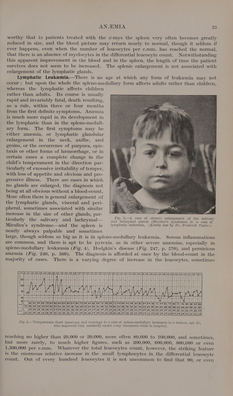 worthy that in patients treated with the a-rays the spleen very often becomes greatly reduced in size, and the blood picture may return nearly to normal, though it seldom if ever happens, even when the number of leucocytes per c.mm. has reached the normal, that there is an absence of myelocytes in the differential leucocyte count. Notwithstanding this apparent improvement in the blood and in the spleen, the length of time the patient survives does not seem to be increased. The splenic enlargement is not associated with enlargement of the lymphatic glands. Lymphatic Leukzemia.—There is no age at which any form of leukemia may not occur ; but upon the whole the spleno-medullary form affects adults rather than children, whereas the lymphatic affects children rather than adults. Its course is usually rapid and invariably fatal, death resulting, as a rule, within three or four months from the first definite symptoms. Anzmia is much more rapid in its development in the lymphatic than in the spleno-medull- ary form. The first symptoms may be either anemia, or lymphatic glandular enlargement in the neck, axilla, and groins, or the occurrence of purpura, epis- taxis or other forms of hzmorrhage, or in certain cases a complete change in the child’s temperament in the direction par- ticularly of excessive irritability of temper, with loss of appetite and obvious and pro- gressive illness. There are cases in which no glands are enlarged, the diagnosis not being at all obvious without a blood-count. More often there is general enlargement of the lymphatic glands, visceral and _peri- pheral, sometimes associated with similar increase in the size of other glands, par- eee ticularly the salivary and lachrymal— — ,,4%,3s4,f%5,,08, “une gulamement ofthe salivary Miculiez’s syndrome—and the spleen is pase are leukemia. (Kindly lent by Dr. Frederick T Taylor.) nearly always palpable and sometimes large, though seldom so big as it is in spleno-medullary leukemia. Serous inflammations are common, and there is apt to be pyrexia, as in other severe anzmias, especially in spleno-medullary leukemia (Fig. 4), Hodgkin’s disease (Fig. 247, p. 570), and pernicious anemia (Fig. 246, p. 569). The diagnosis is afforded at once by the blood-count in the majority of cases. There is a varying degree of increase in the leucocytes, sometimes a £ 3 hiy dd ee FAHRENHEIT [= 8 Fig. 4—Temperature chart (morn:ng and evening) in a case of spleno-medullary leukemia in a woman, age 41, who improved very markedly under z-ray treatment while in hospital. reaching no higher than 20,000 or 30,000, more often 80,600 to 100,000, and sometimes. but more rarely, to much higher figures, such as 200,000, 600,000, 800,600 or even 1,500,000 per c.mm. Whatever the total leucocytes count, however, the striking feature is the enormous relative increase in the small lymphocytes in the differential leucocyte count. Out of every hundred leucocytes it is not uncommon to find that 90, or even