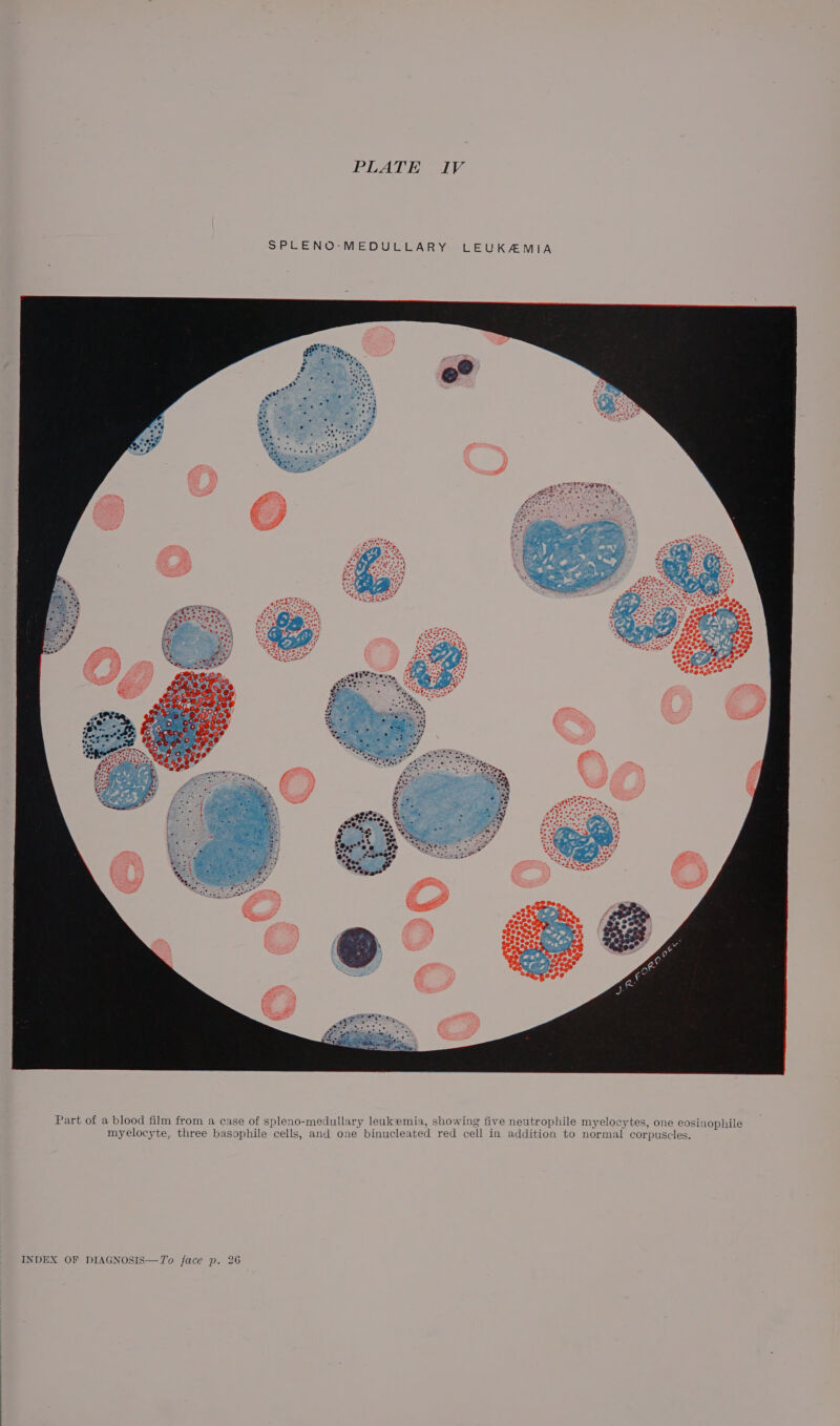 SPLENO-MEDULLARY LEUKAMIA Part of a blood film from a case of spleno-medullary leukemia, showing five neutrophile myelocytes, one eosinophile myelocyte, three basophile cells, and one binucleated red cell in addition to normal corpuscles.